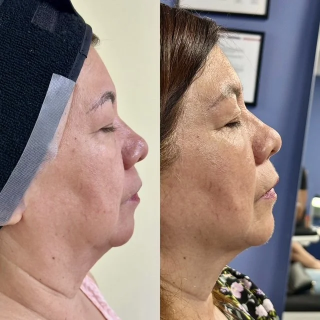 Comparación antes y después de un procedimiento de lifting facial en una mujer, mostrando mejoras en la firmeza y apariencia de la piel.