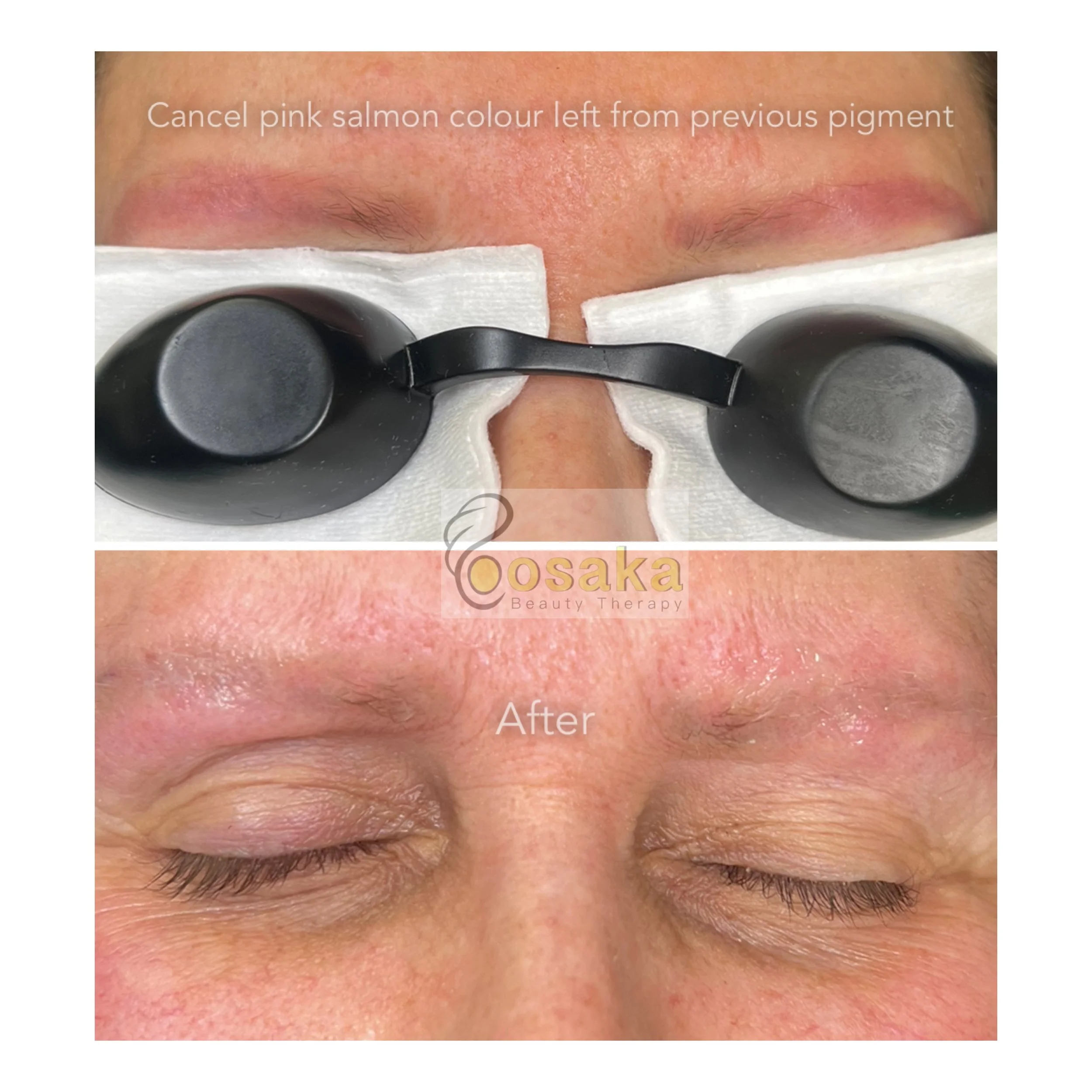 Laser removal (For Brows only)