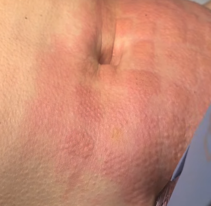 Close-up of skin with textured, uneven surface and redness.
