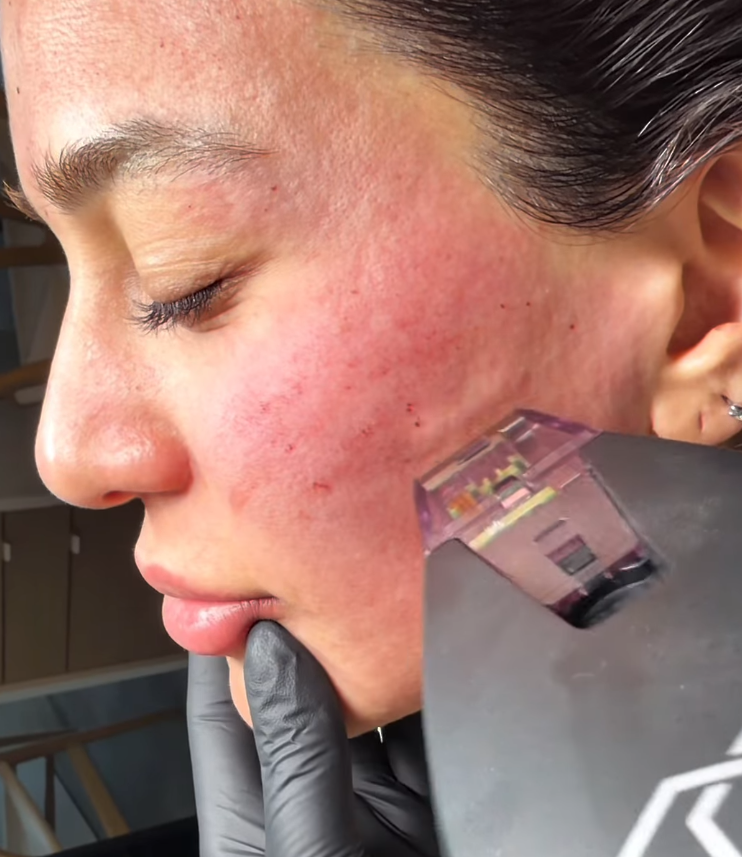 A woman with facial redness undergoing laser skin treatment on her cheek by a professional wearing gloves.