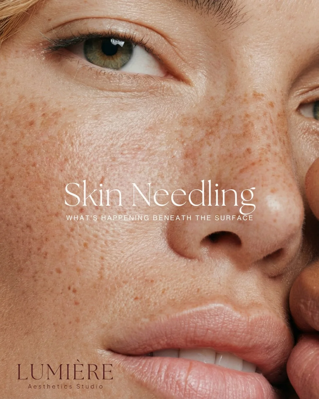 How does skin needling work? ✨

Step 1: Controlled micro-channels are created in the skin.

Step 2: The skin recognises these micro-channels as a controlled injury, triggering its natural healing response.

Step 3: Collagen and elastin production is 