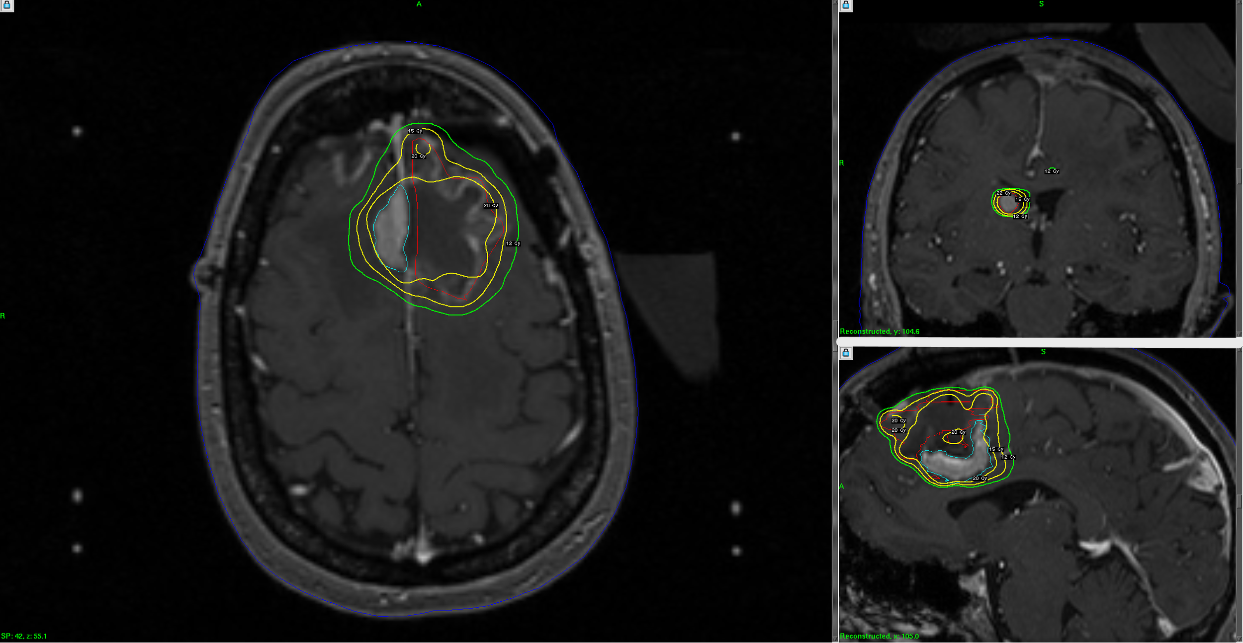 Gamma Knife stereotactic radiosurgery treatment plan showing focused radiation targeting of a brain tumor while limiting dose to surrounding normal brain.