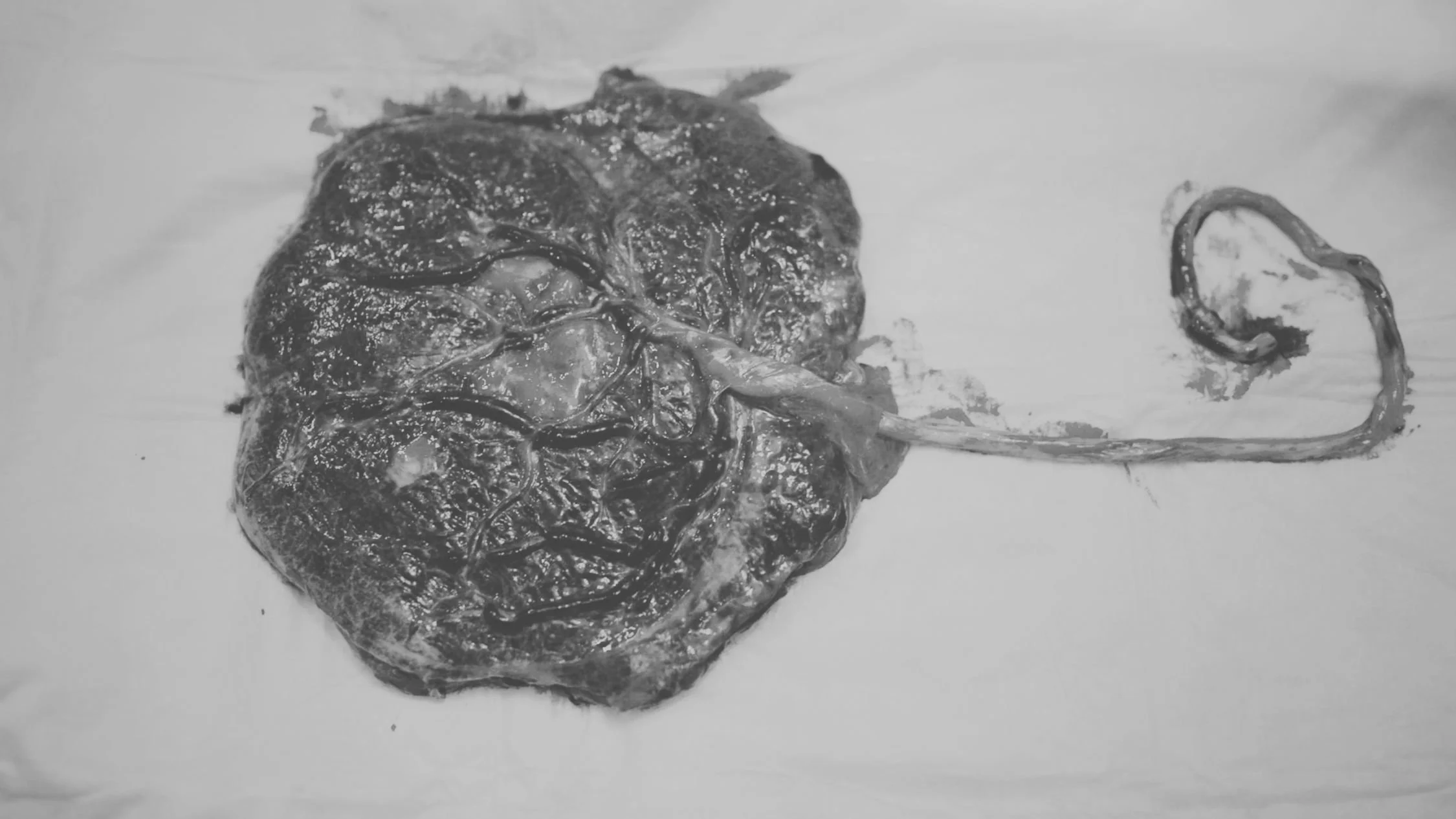 A black and white photograph of a dissection specimen, showing a large, textured organ or tissue with a hooked instrument inserted into it.