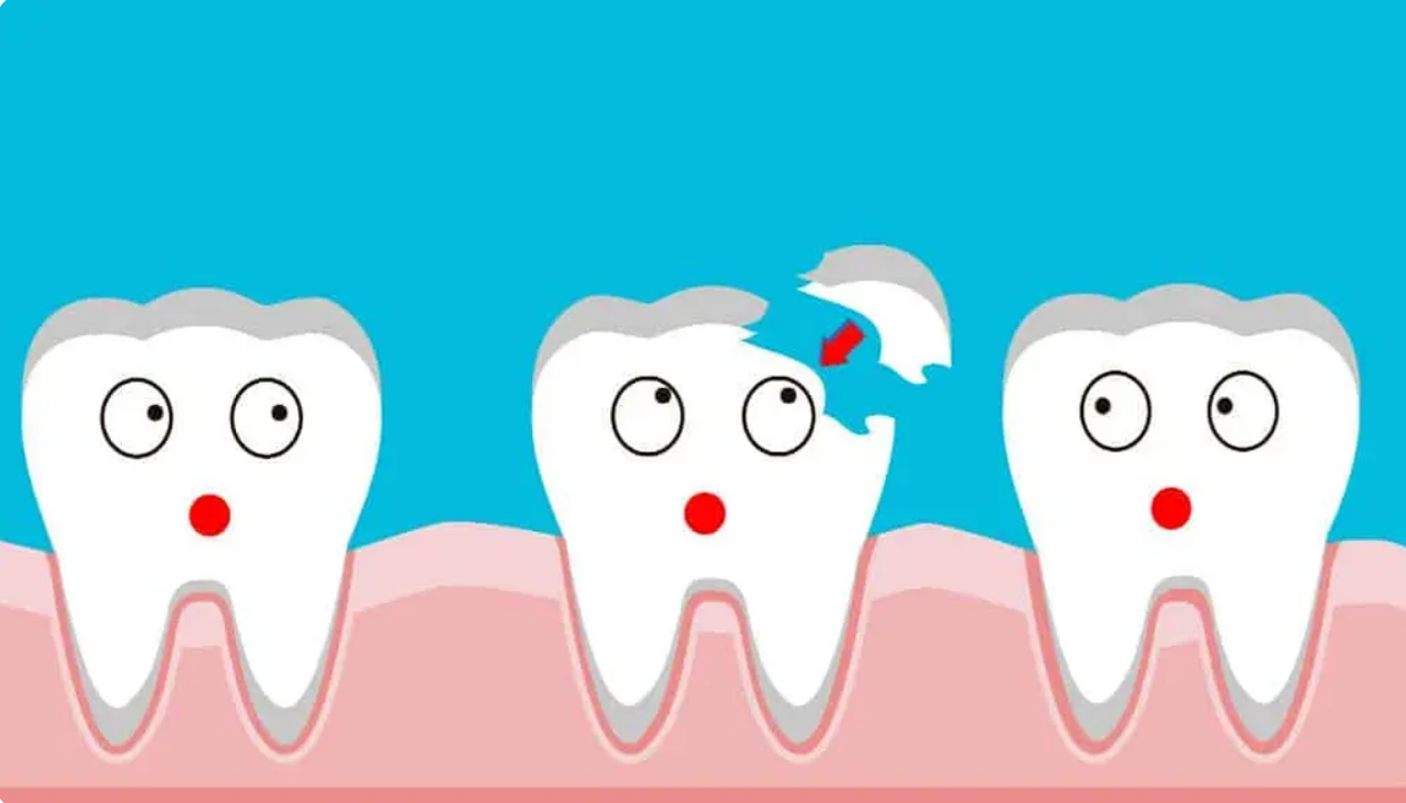 Chipped or Cracked a Tooth? Here's Exactly What to Do