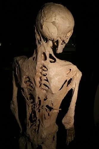 World’s Rarest Disease