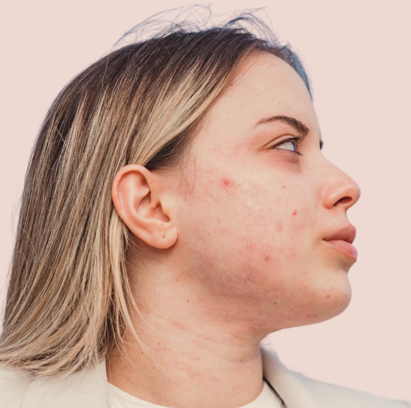 Profile of a woman with acne on her cheek, chin, and jawline, with blonde hair and a light pink background.