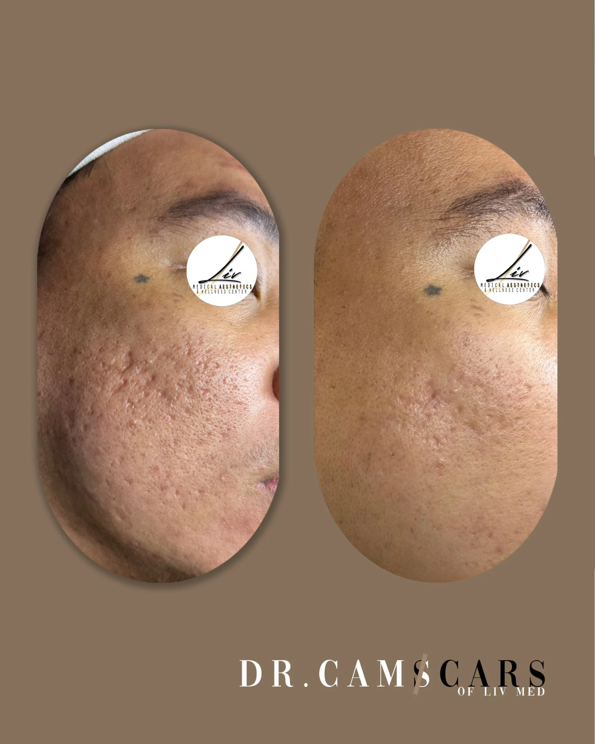 Results don&rsquo;t lie! Real patients go back in Liv!
Client update: combination treatment of TRINITY PLUS &amp; Juvelook with FREE Skinpen