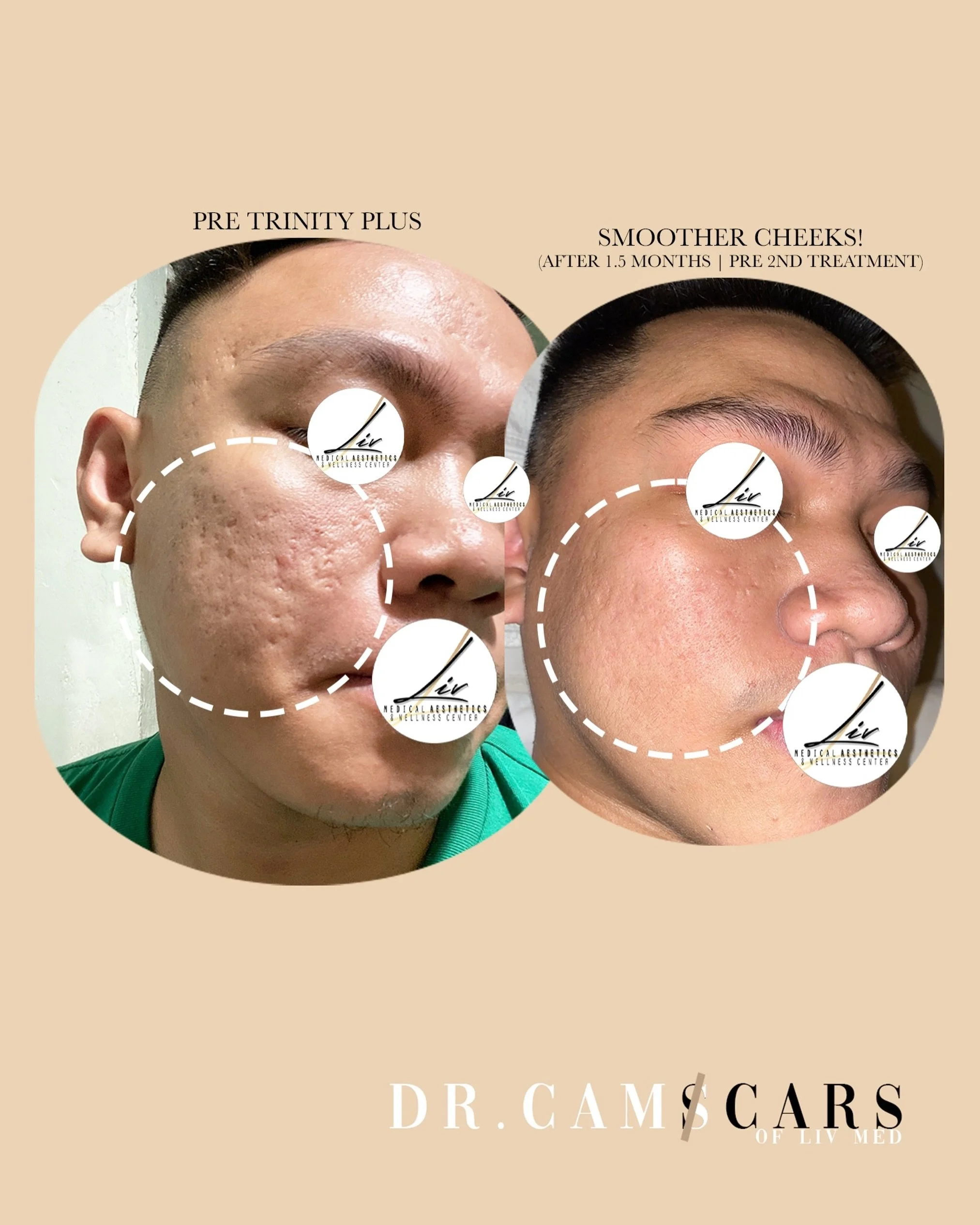 Client update: patient had acne scars and did 1 session of trinity plus and 2nd photo was after 1.5months and prior his second session of trinity plus.