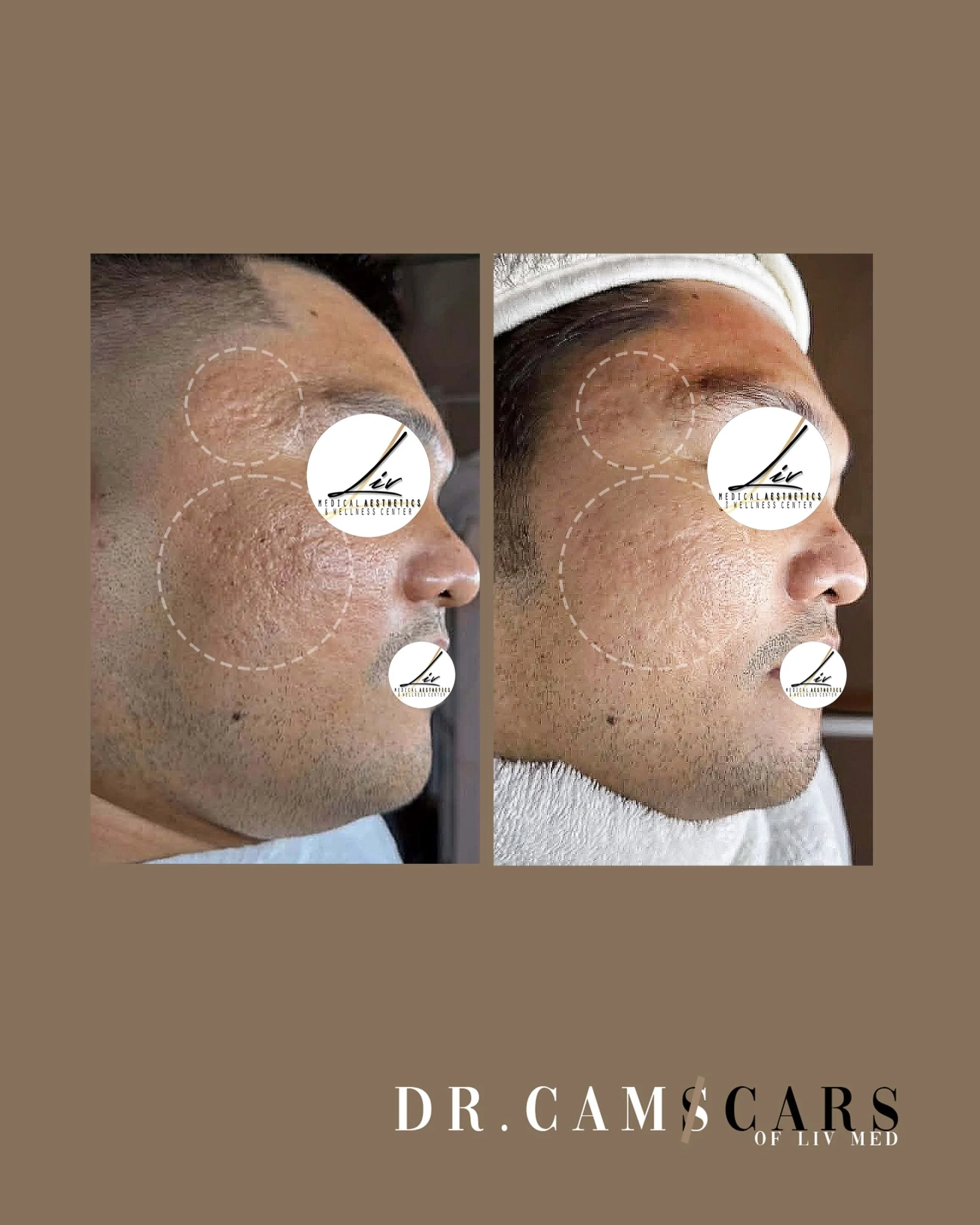 5 procedures, 1 session.
TRINITY PLUS acne scar treatment!🤍

Smoother skin, Visible results!
More acne scar RESULTS @dr.camscars ✨

INQUIRE AND BOOK NOW!🤍
Liv,&rdquo;life with elegance!&rdquo;

2nd flr 125 Maginhawa st. QC
09565667690
@livmedicalae