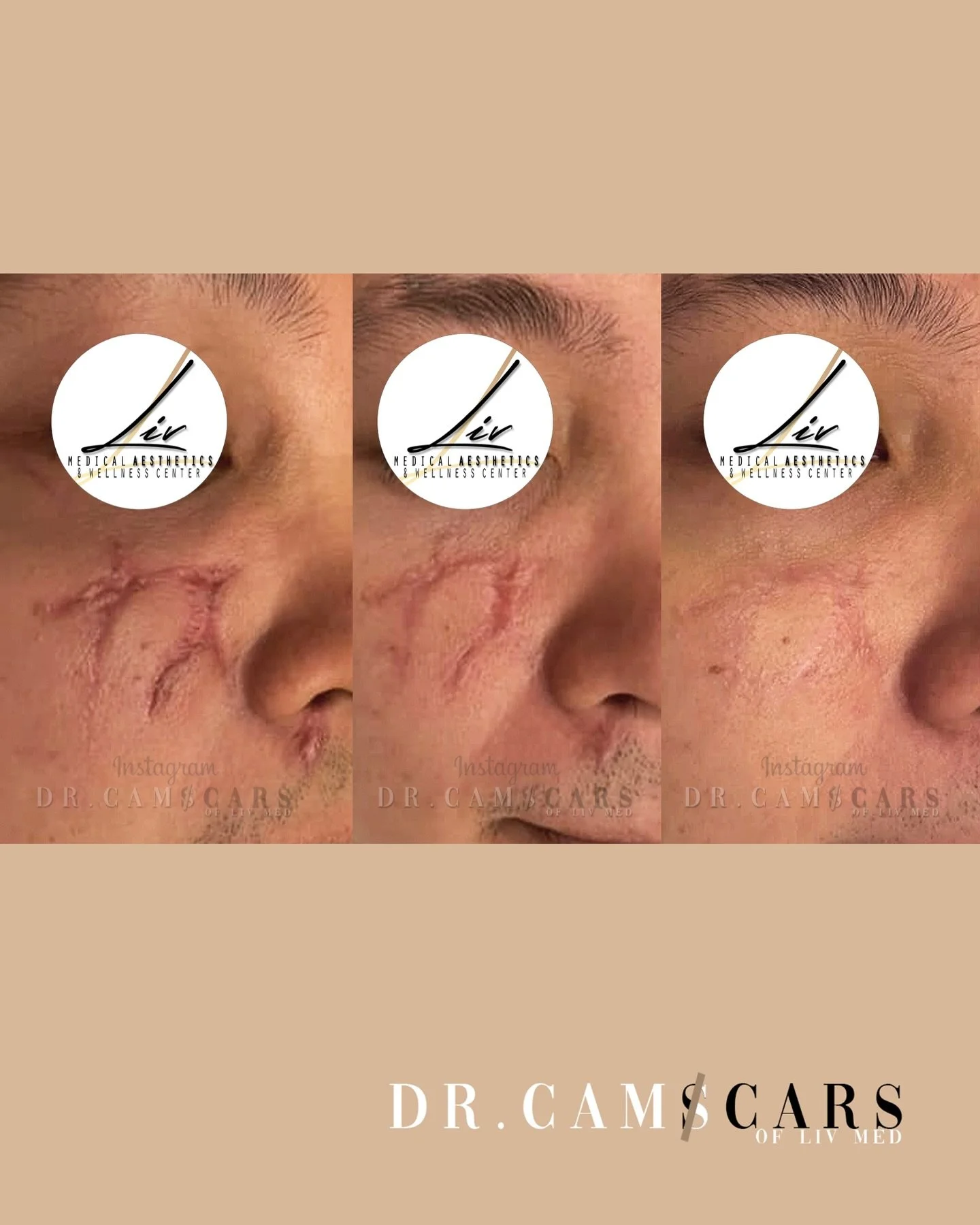 Client&rsquo;s journey:
Patient experienced motorcycle accident that caused his Scars on right cheek and lower nostril area. Went to Liv Med to seek for aesthetic needs, personalized treatment plan was made. After just only 6 SESSIONS of intervention