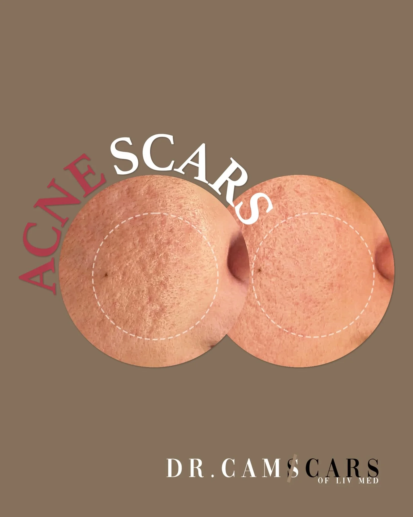 Rolling scars gone with Trinity plus.