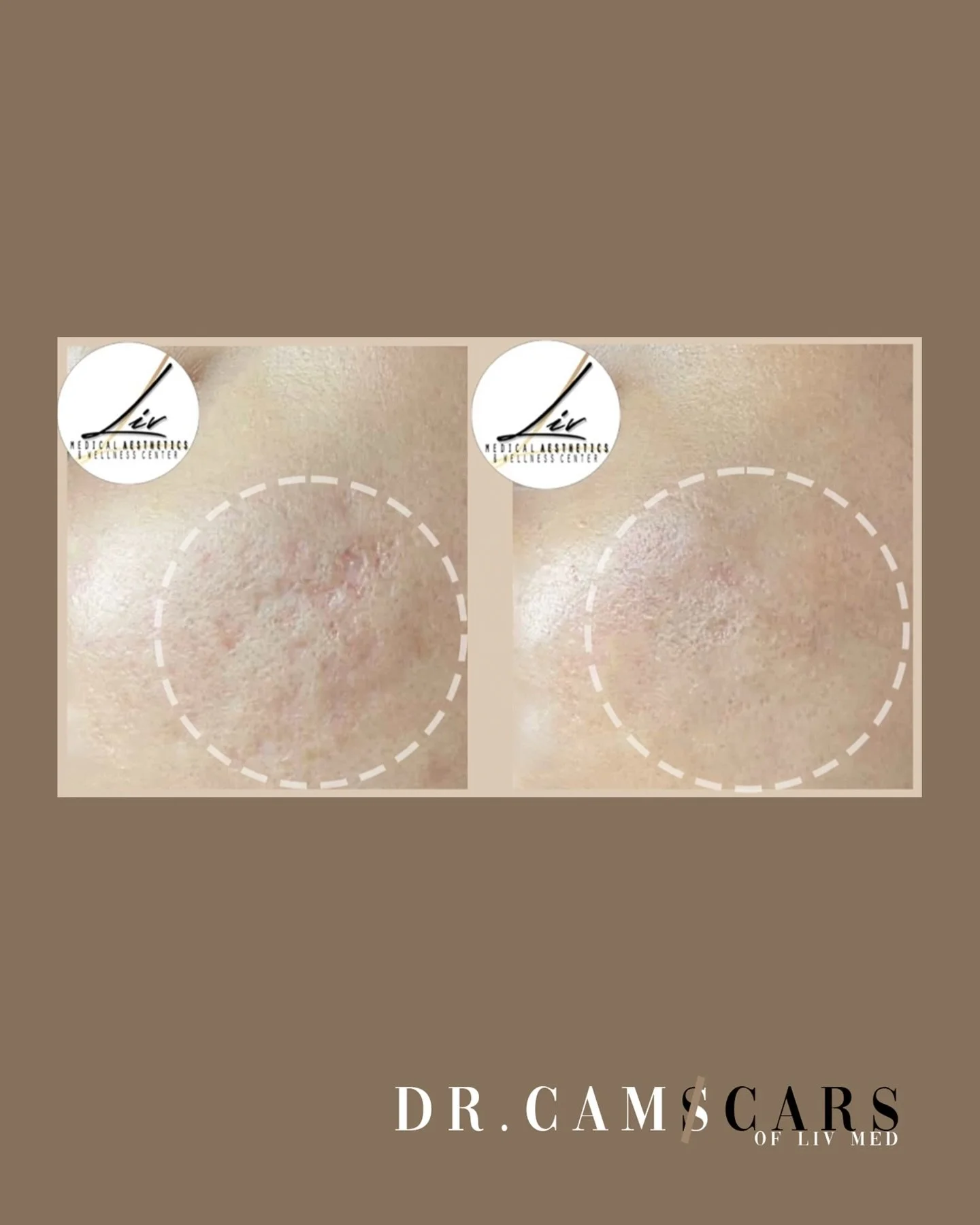 Client update:
Started her Trinity PLUS in Liv Med last October 2025 for Her Acne scars. Followed by Juvelook + Skinpen last December 2025.

Current state January 2026: Acne scars smoother; for Juvelook + Skinpen today!

Skin status, recovery &amp; t