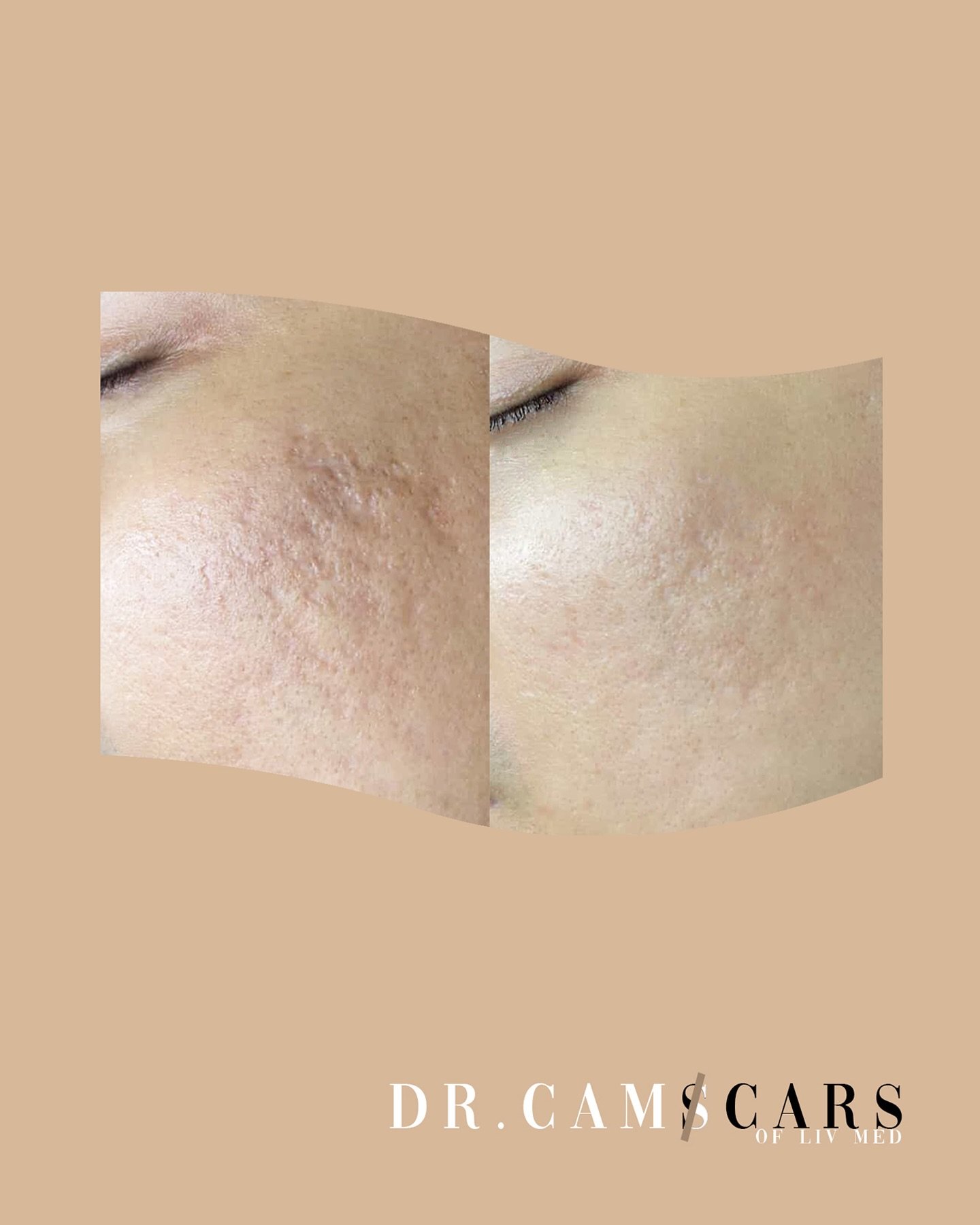Client update: patient had session of Juvelook with free skinpen and trinity plus 5 procedures in 1 session.