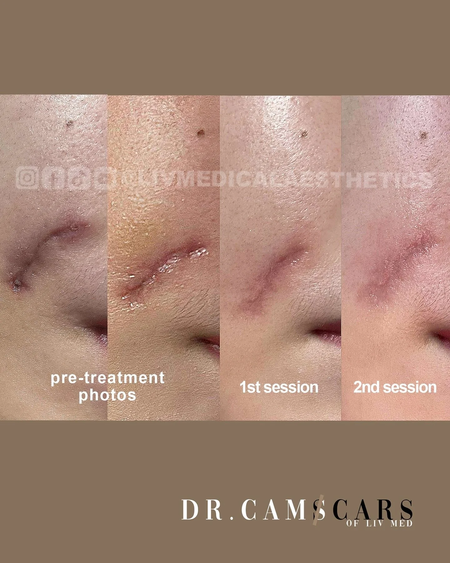 Client Update: Patient had post deep wound scarring, Juvelook treatment done with 2 sessions only. Post 1st session, visible resurfacing of scars. Post 2nd session, skin almost smoothened and only visible redness remains.