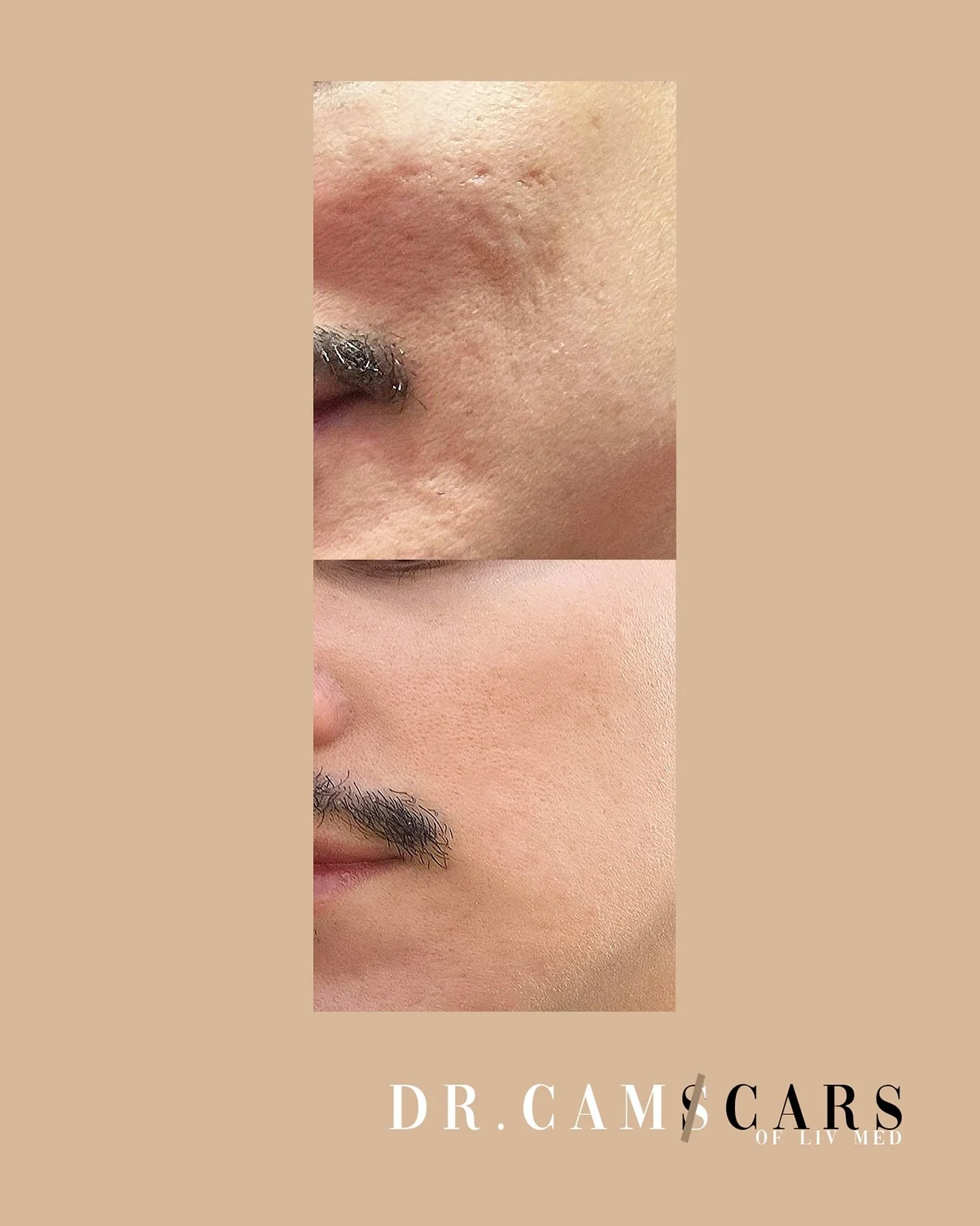 Patient update: patient had combination of trinity plus (2), skin pen(1), juvelook(2). Prior juvelook i prioritized to manage his acne scars first with trinity plus together with skinpen. After scars were smoothened, Juvelook was done for better skin