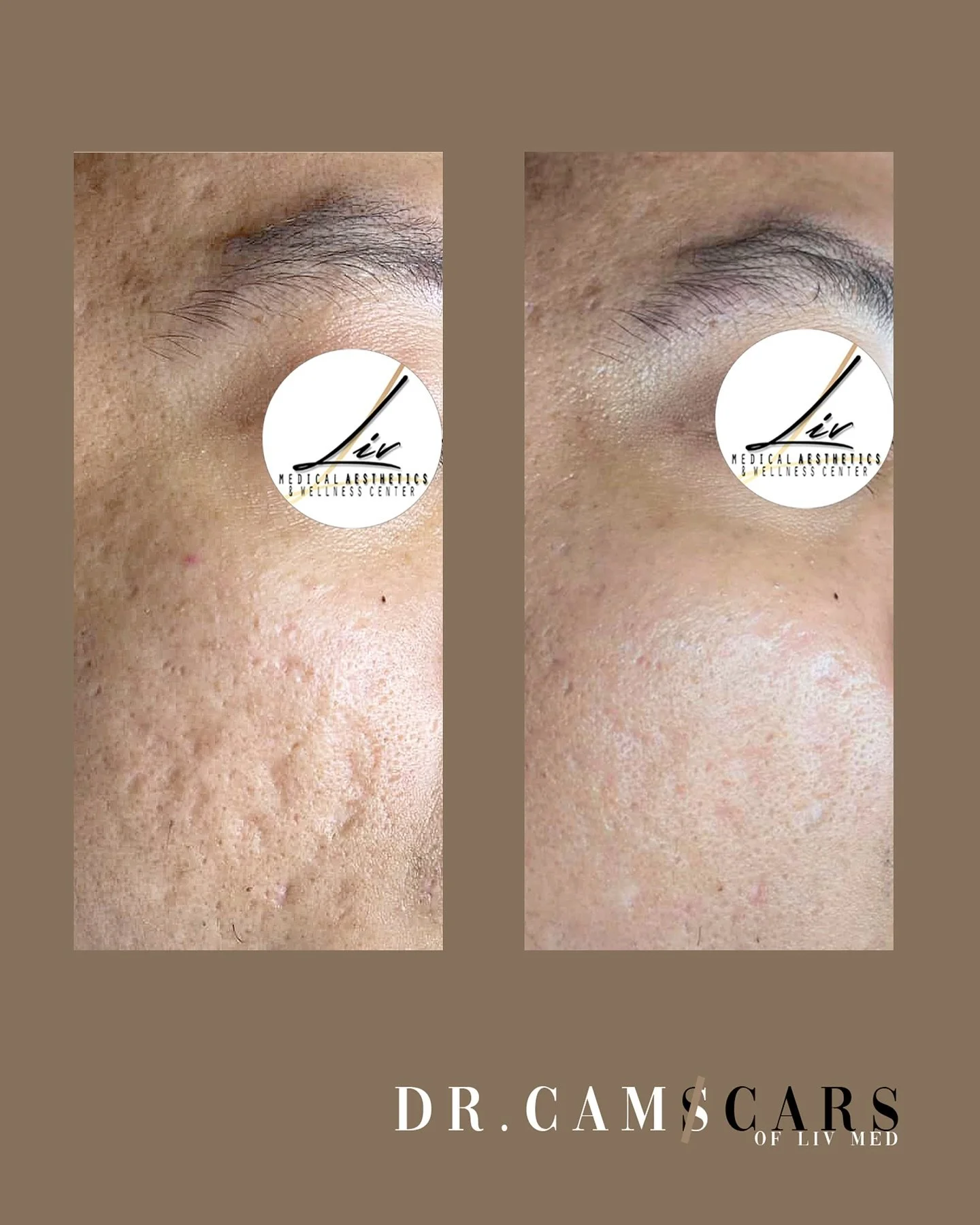 Client update: patient had trinity plus &amp; Juvelook to improve his scars on cheeks. Combination of these procedures will provide great results.