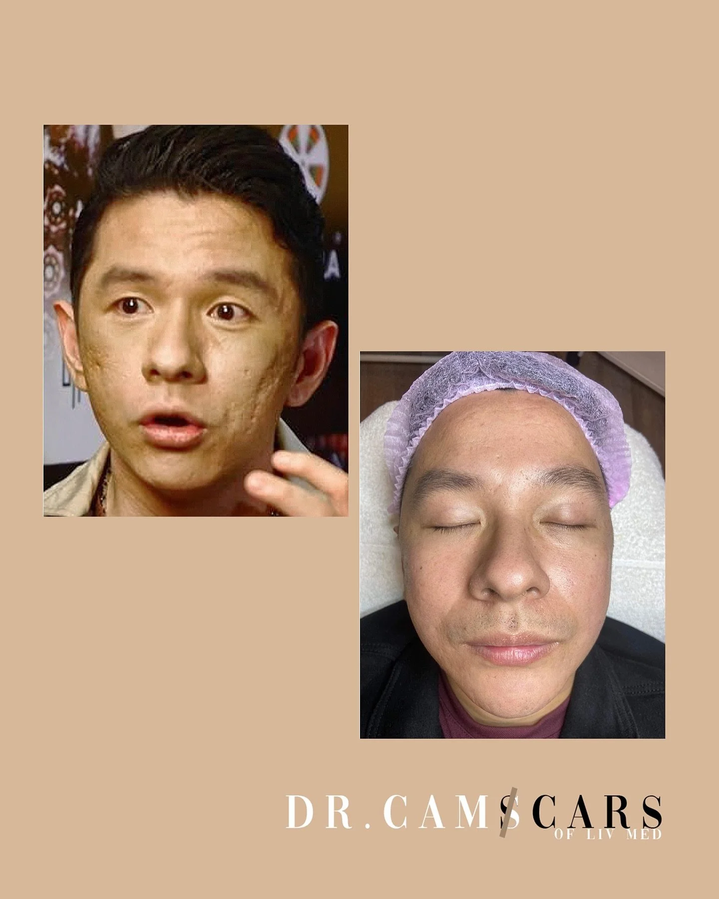 Sir Marc Solis acne scar journey.

🚨Trinity Acne scar treatment 3 in 1
-this treatment is without Co2 laser since sir Marc needed to recover fast from downtime due to taping schedules

🚨Trinity Plus 4 in 1
The treatment choice for all kinds of sir 
