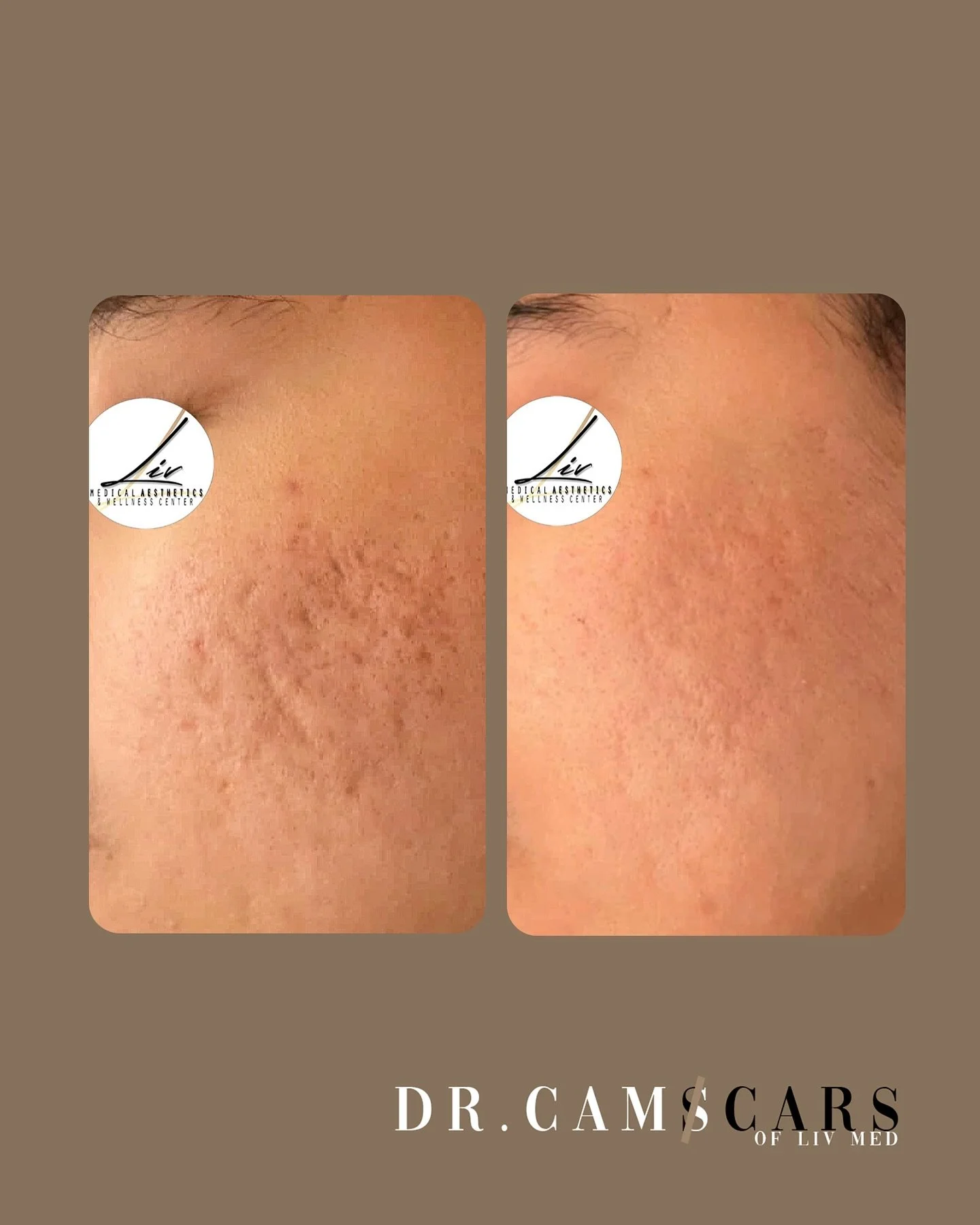 Client update:
2 Trinity plus treatments done, 1 juvelook with 1 month interval. Skin resurfaced and dark marks lightened.