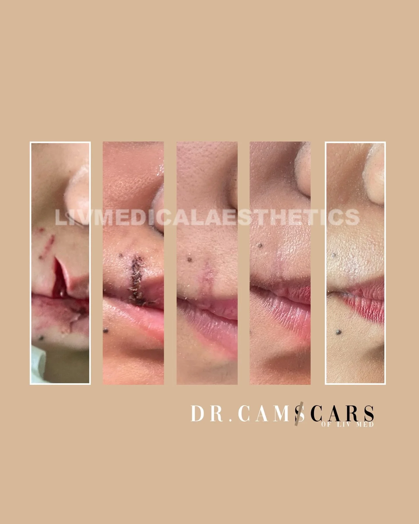 Client had lacerated scars due to accidental dog bite. 2 weeks post suture removal, patient had injections and laser treatments in Liv Med. 

Treatment period from October 2024 to March 2025 with monthly interval.