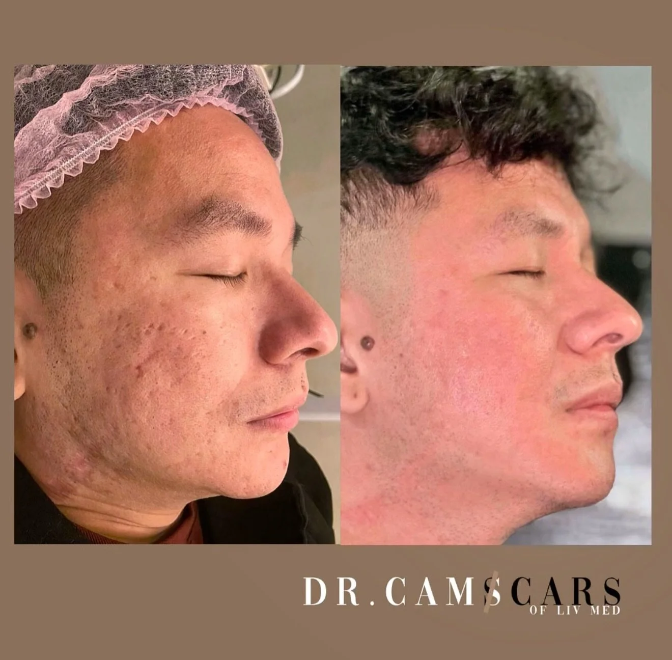 FAQs on Acne scar Treatments!

Is his skin now perfect? 
A: No! But it greatly IMPROVED his acne scars!

Are there scars left?
A: Yes! But now it&rsquo;s minimal &amp; subtle! DEEP Scars no longer visible!

How long is the DOWNTIME?
A: On his Update 