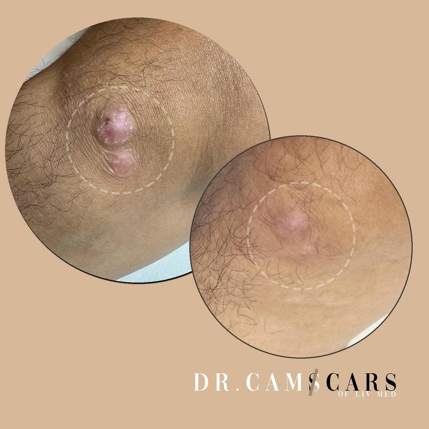 Client update: started Keloid steroid injections to lessen the thickness and flatten up the scars.