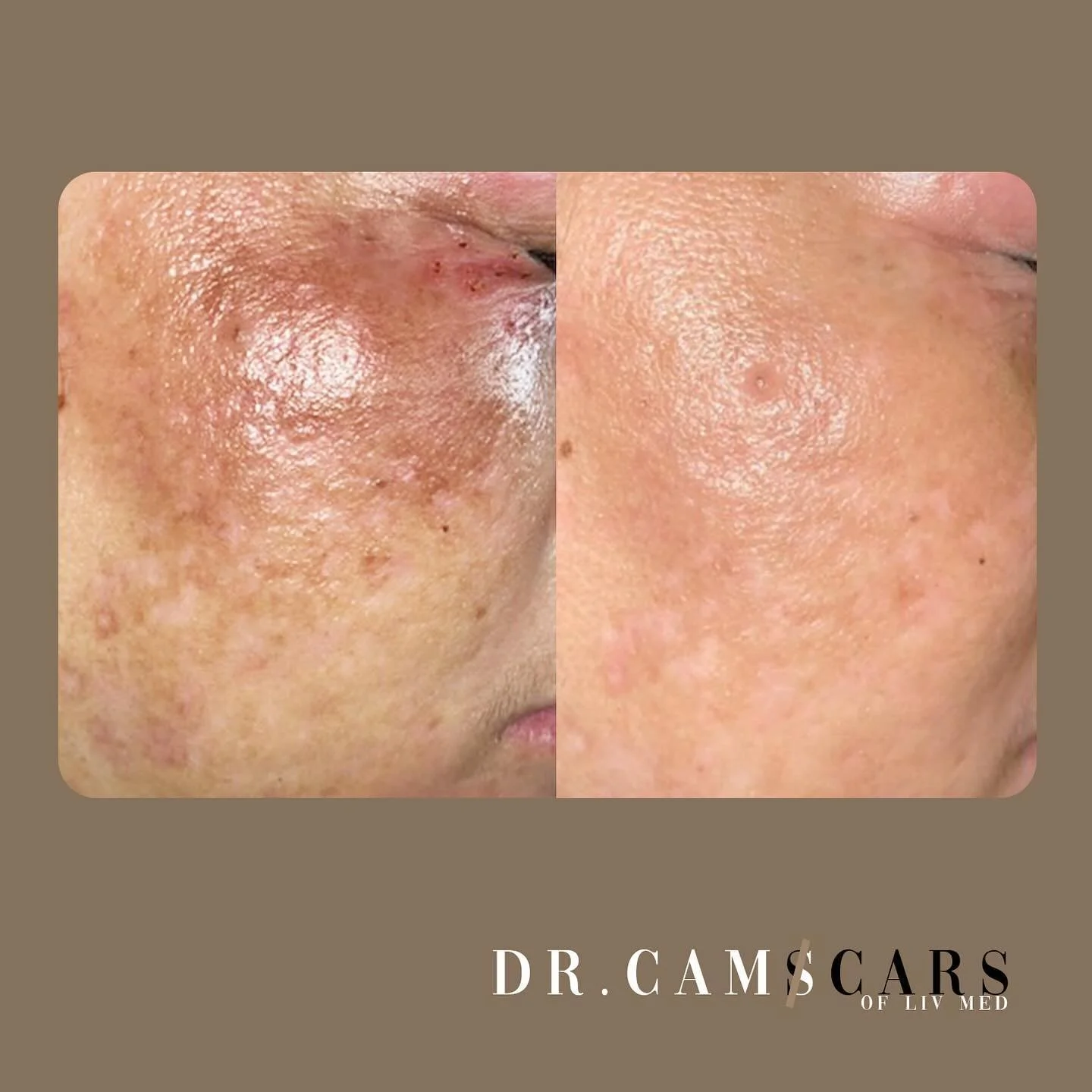 Client update: 3 sessions of 5G laser &amp; Meline injection!
INQUIRE AND BOOK NOW @livmedicalaesthetics !🤍

2nd flr 125 Maginhawa st. QC
Tuesday-Sunday: 10am to 8pm
09565667690

#meline #5gwhitelase #melasma #whitening #darkspots