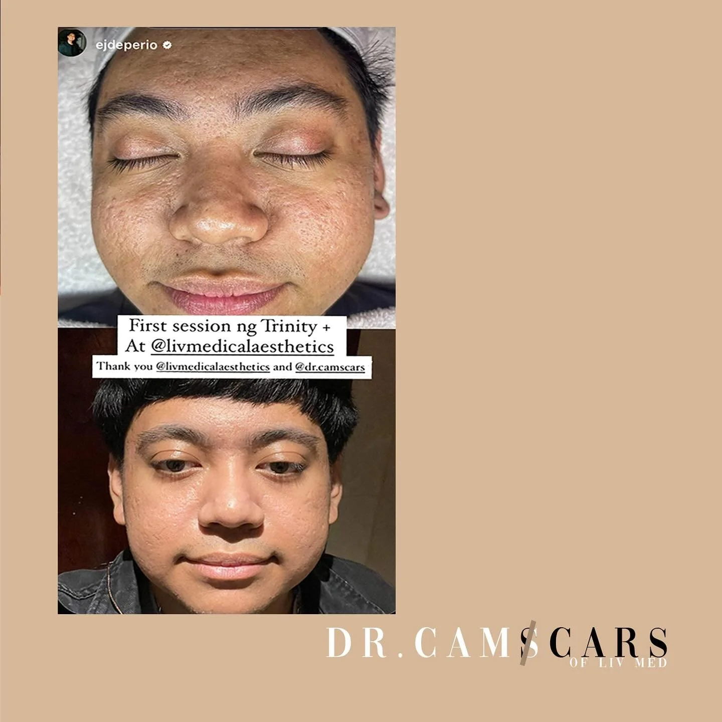 Singer/ Songwriter sir EJ had 1 session of Trinity Plus. Overall skin texture smoothened &amp; now clearer. Client had multiple ice pick scars and valley scars that were addressed with TCA cross &amp; Subcision with Biofillers.