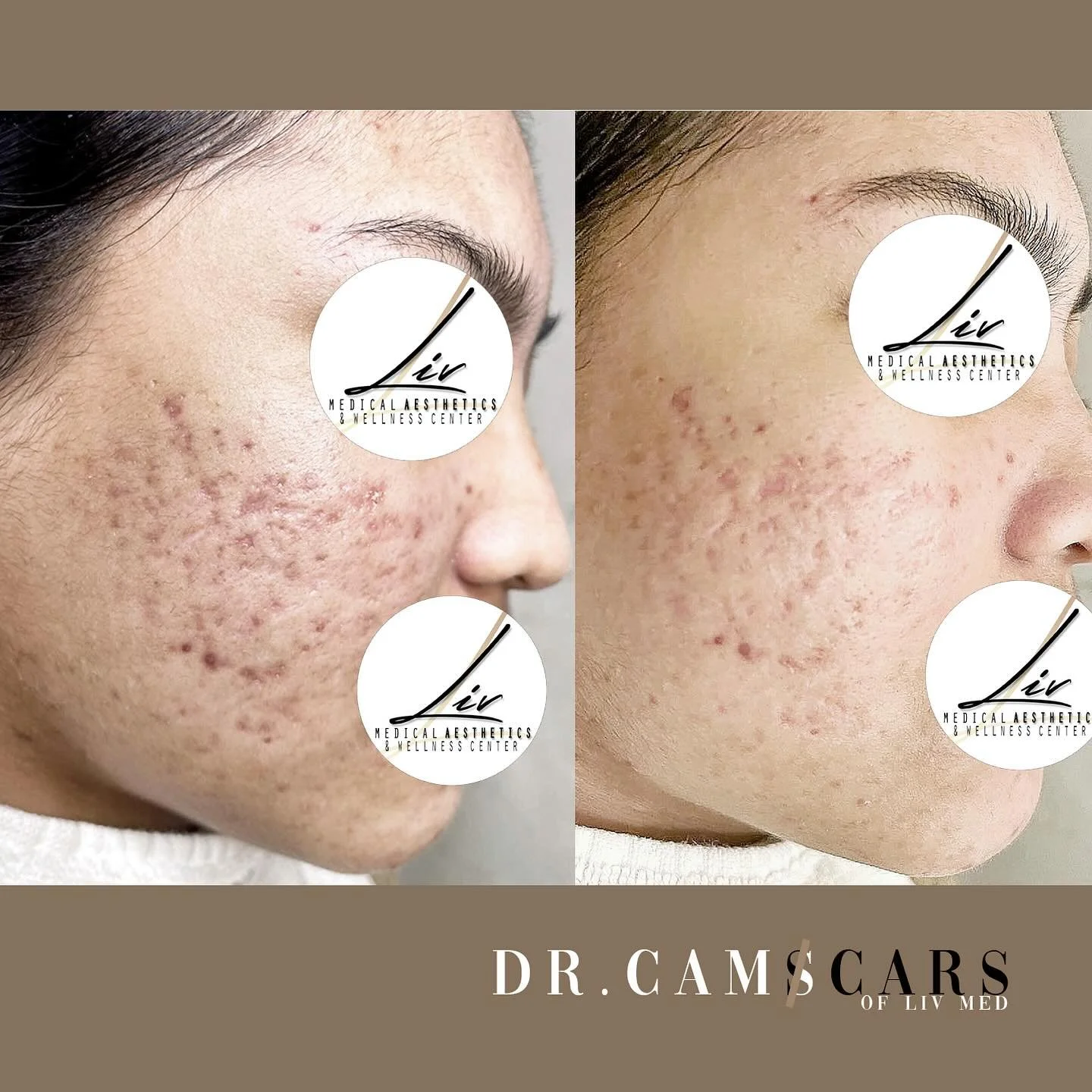 FAQ: What can Trinity plus treatment do with just 1 session?

1. TCA CROSS: will target your pitted/ice pick scars thus will promote elevation of scars!

2. Subcision w/ Biofillers: 
-SUBCISION will release scars from underlying tissue!
-BIOFILLERS w