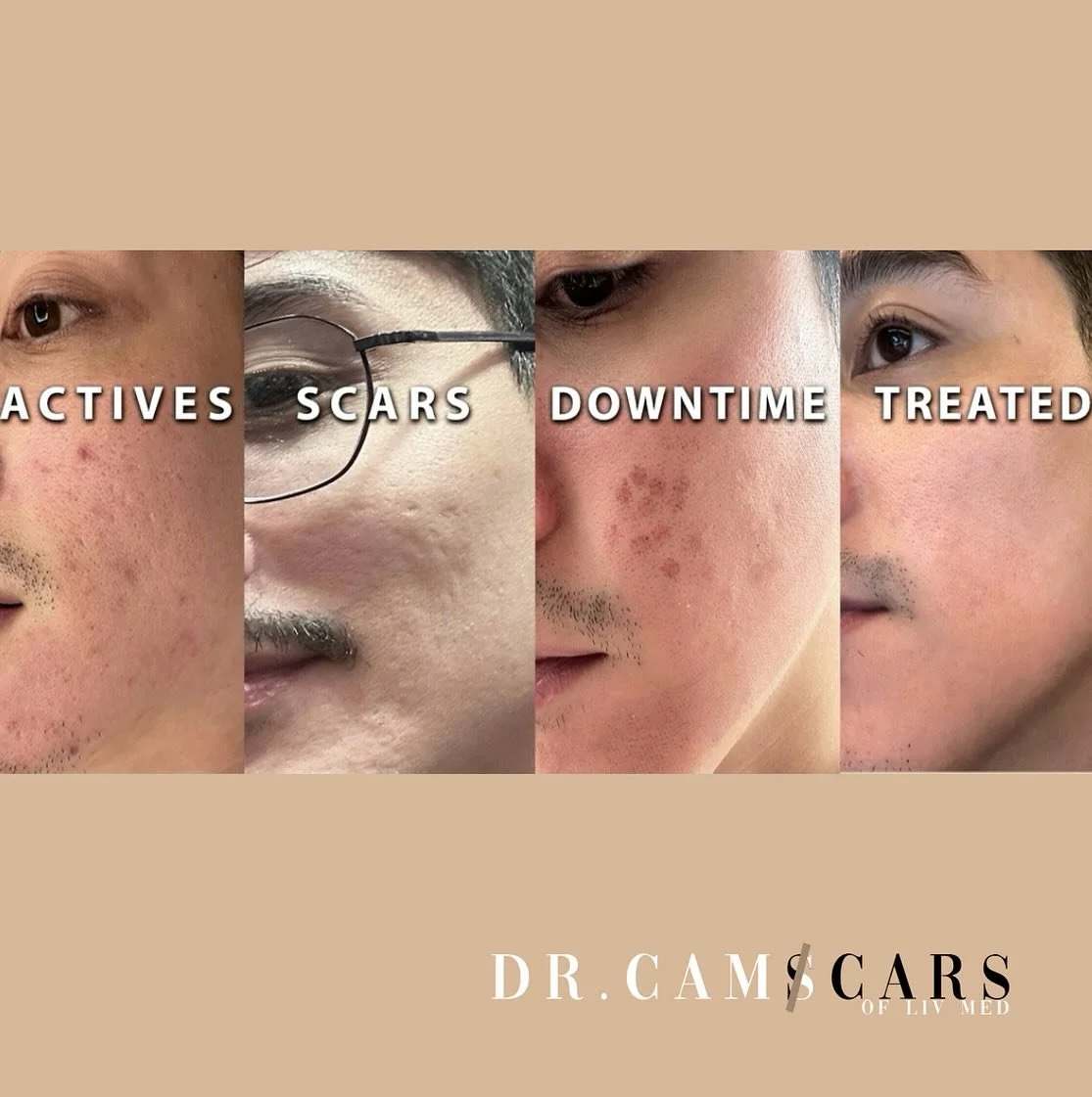 From actives pimples, scars to clearer skin.
Trinity +plus and rejuran s injection done.