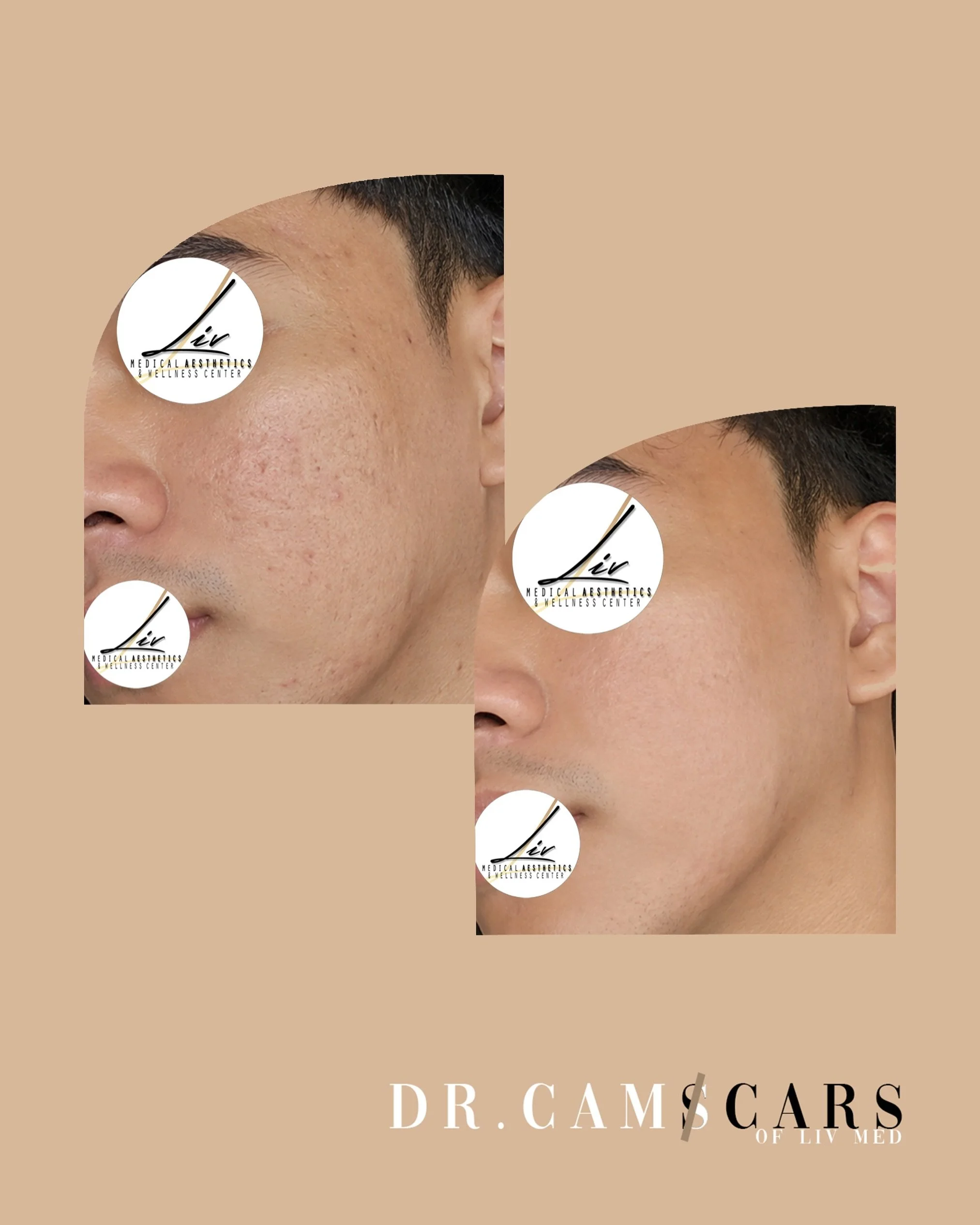 6 months personalized Acne scar treatments to make his skin smoother. Combinaiton of Trinity plus, Rejuran s, Juvelook with skinpen.