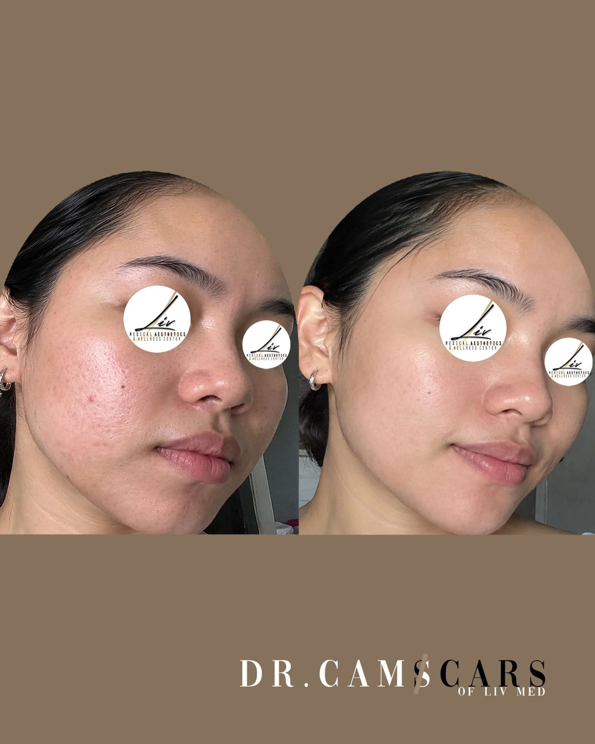 Combination of Trinity plus treatment and Juvelook with make your skin glow up. Glass skin effect shown on the after photo. #acnescartreatment #rejuvenation