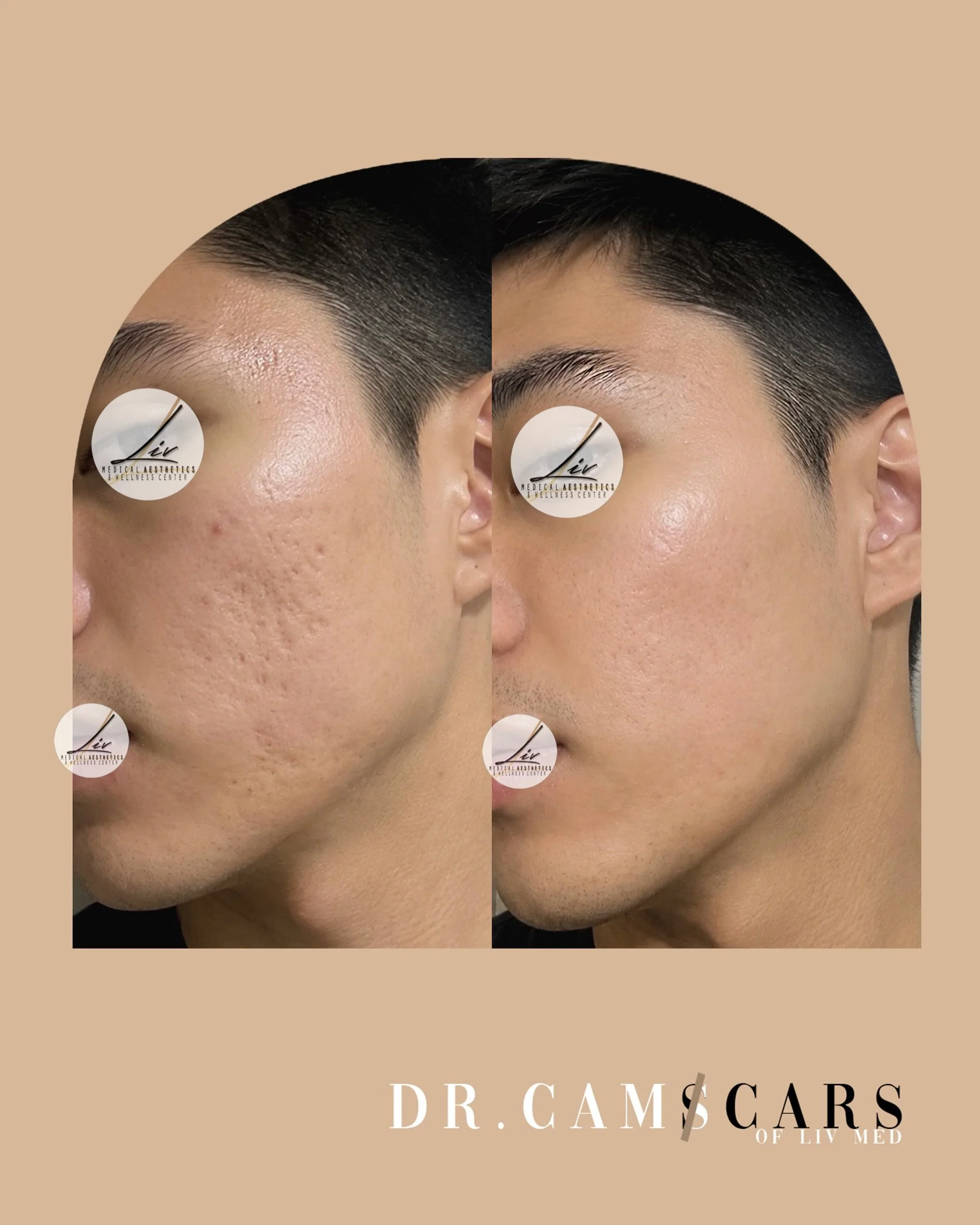 Combination of Trinity Plus with Juvelook x skinpen. Fractional and Peptide combo done.