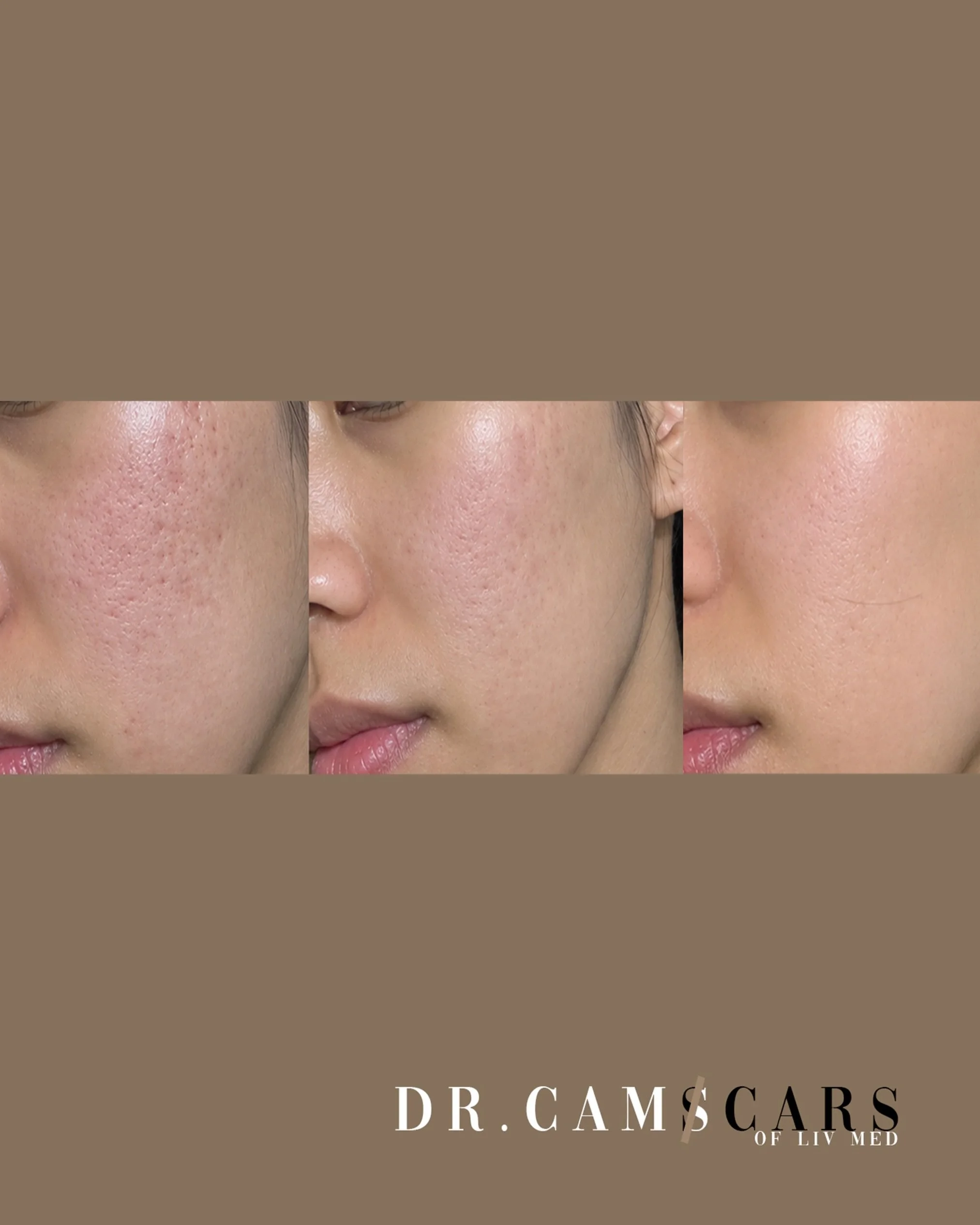 Combination treatment of Fractional Laser with GHK-Cu Peptide. Results shown clearer and smoother skin.