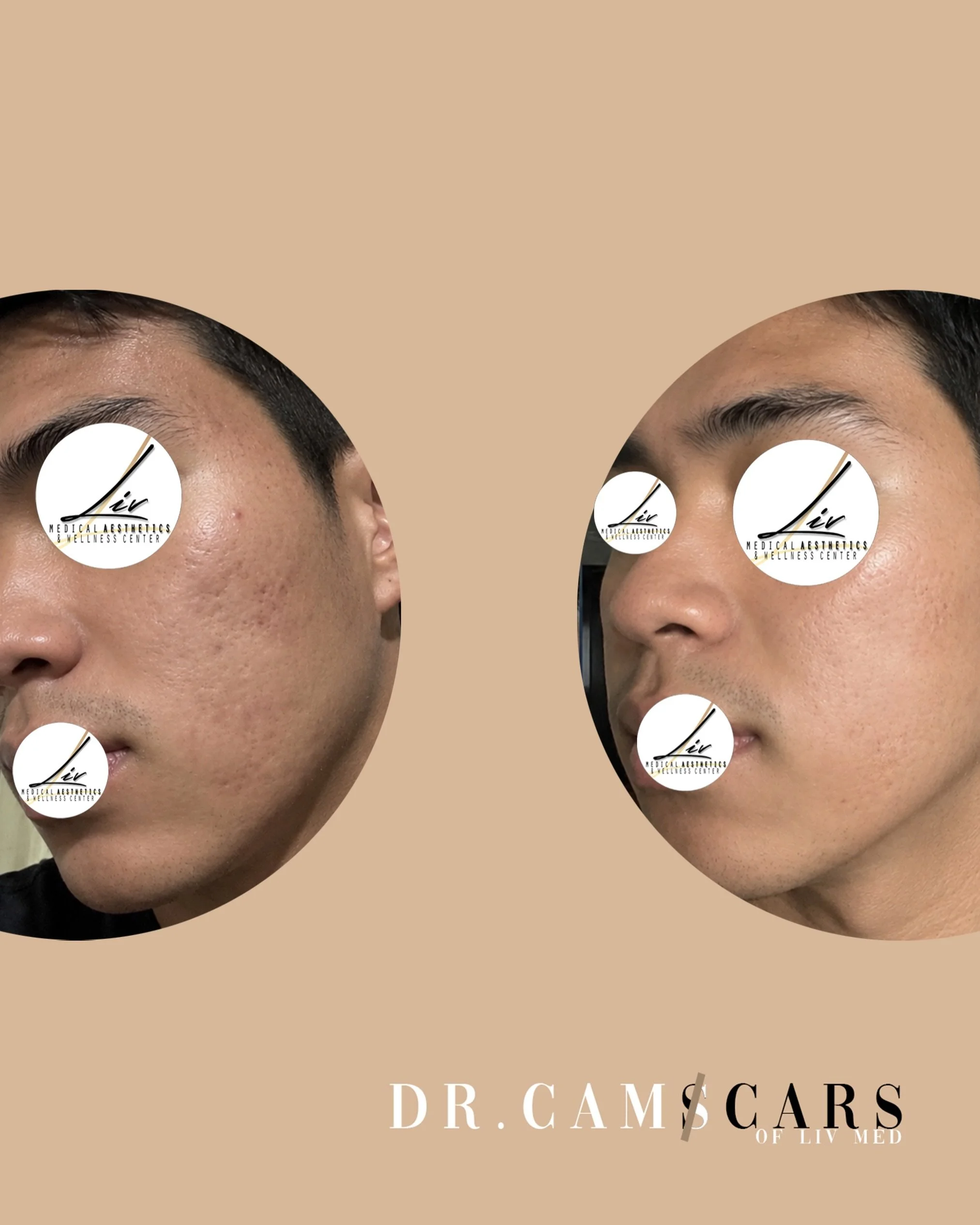 Trinity plus for 5 sessions with 1-2months interval for his acne scars.