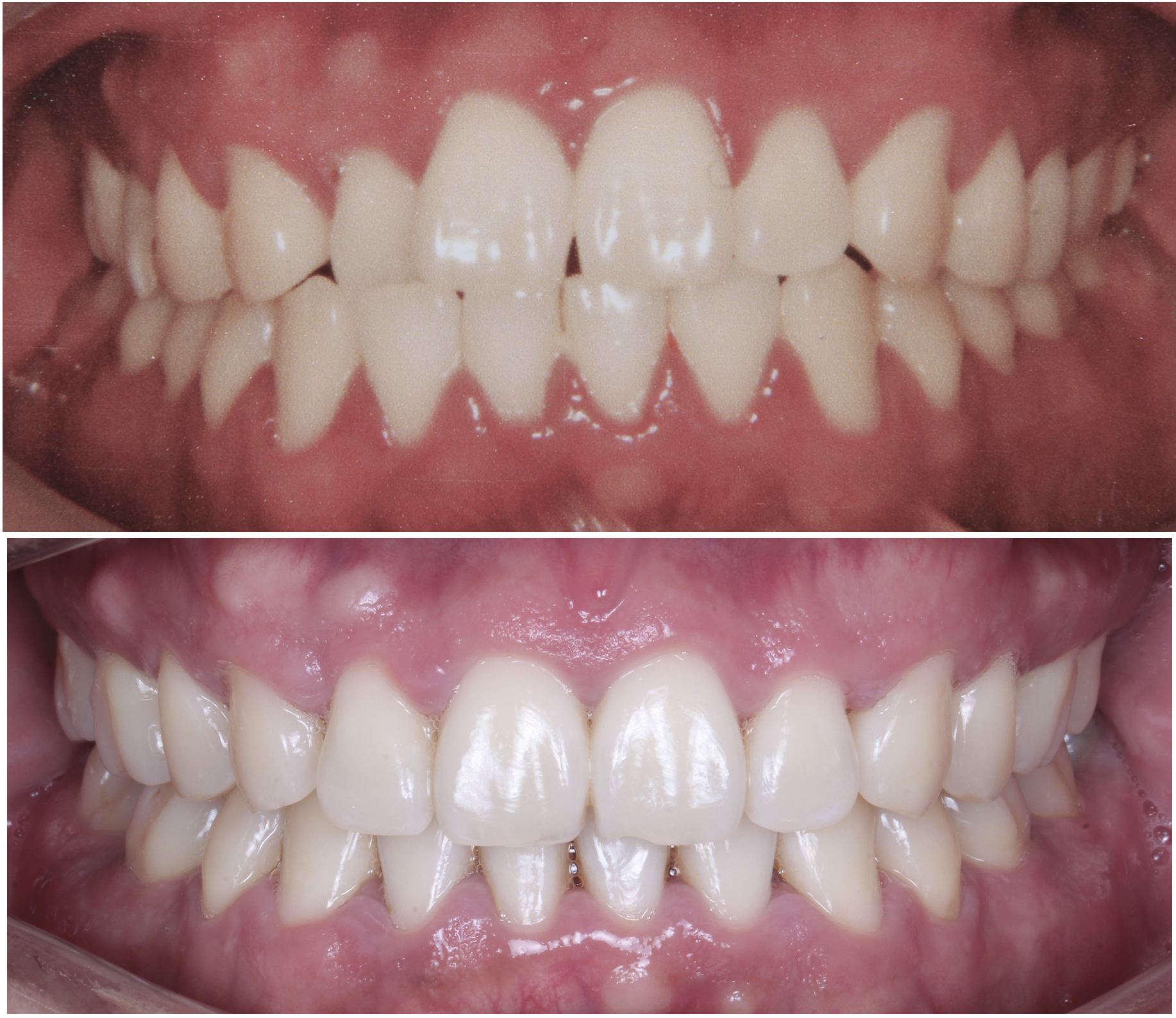 Close-up images of teeth before and after dental whitening treatment.