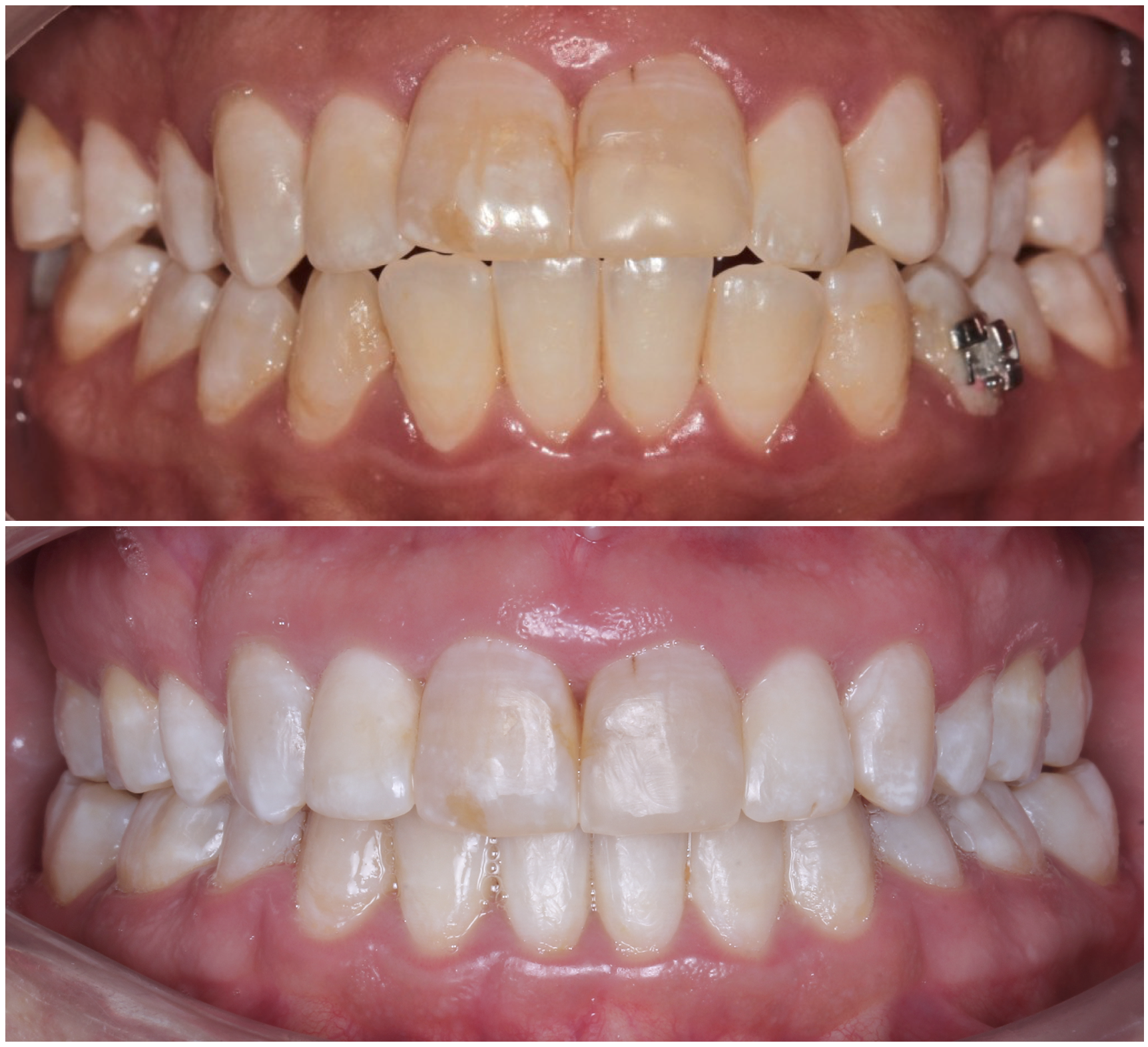 Close-up view of a person's upper and lower teeth before dental treatment, showing misaligned teeth and an orthodontic bracket on the lower right molar.