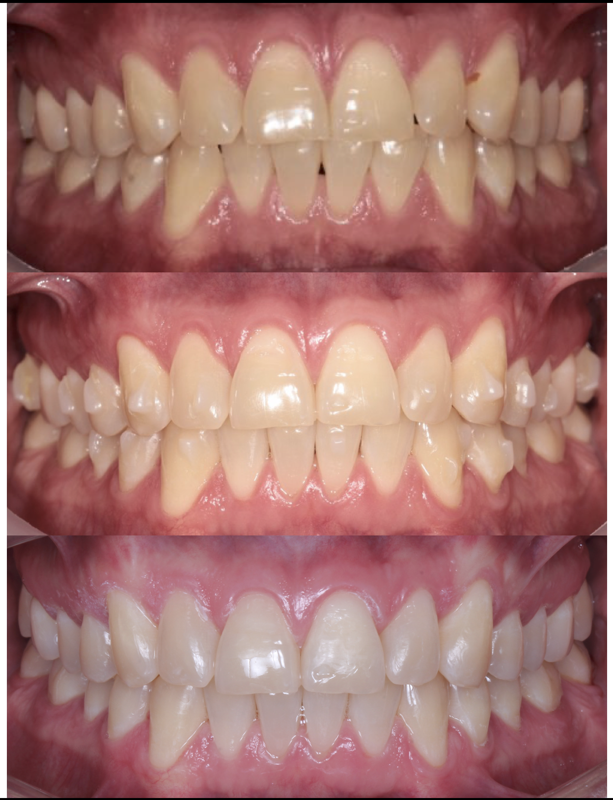 Three sets of human teeth showing progression from misaligned and stained teeth to well-aligned, clean teeth, illustrating dental improvement or whitening process.