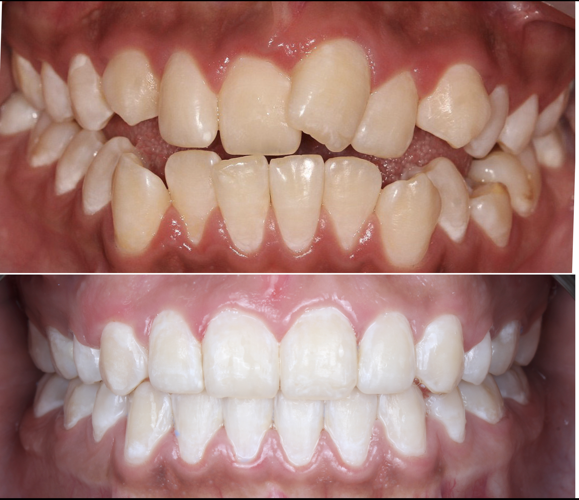 Close-up of a person's mouth showing teeth with crowding and misalignment in both upper and lower jaw.