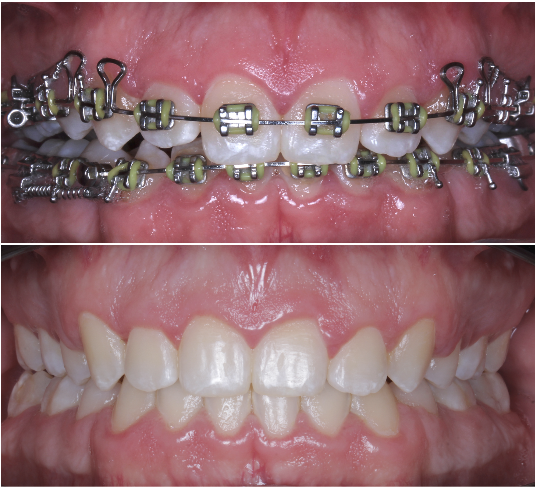 Close-up of a person's upper teeth with braces, metal brackets, wires, and yellow elastics. The teeth are in the process of orthodontic treatment.