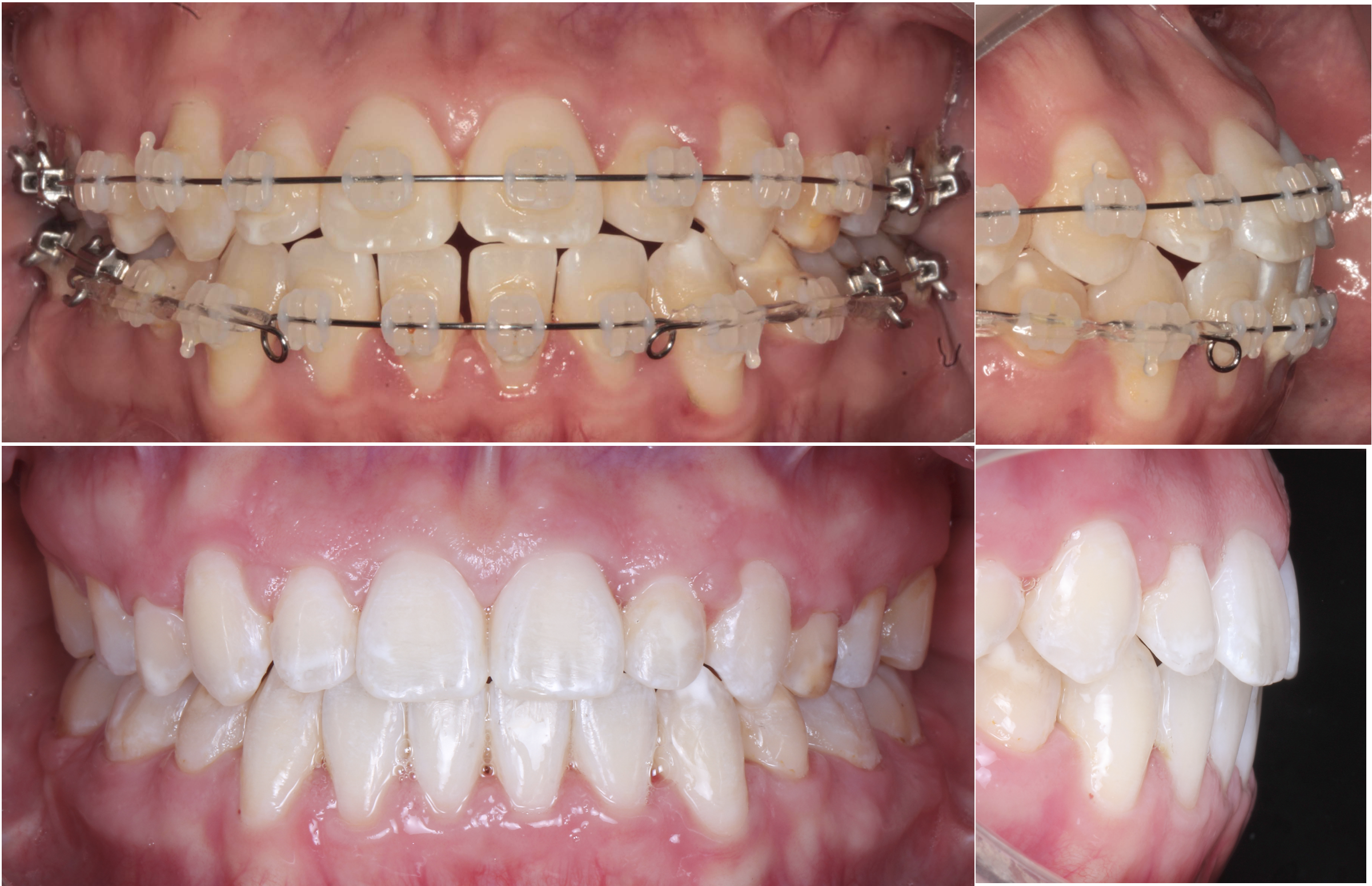 Close-up of a person's teeth with braces, showing the upper and lower teeth with metal wires and brackets.