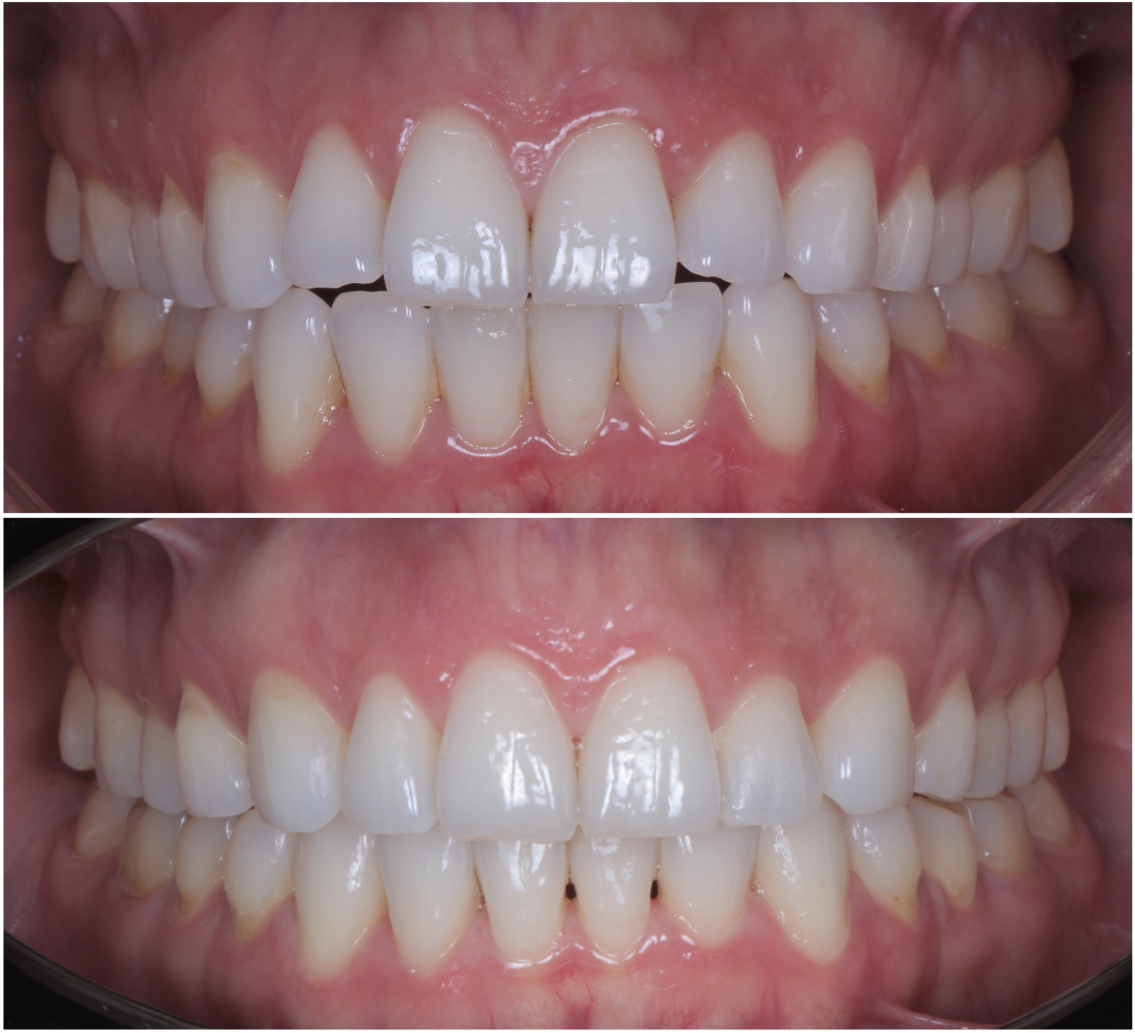 Close-up of a person's teeth showing a comparison of orthodontic treatment results, with the top image showing teeth before treatment and the bottom image showing teeth after alignment.