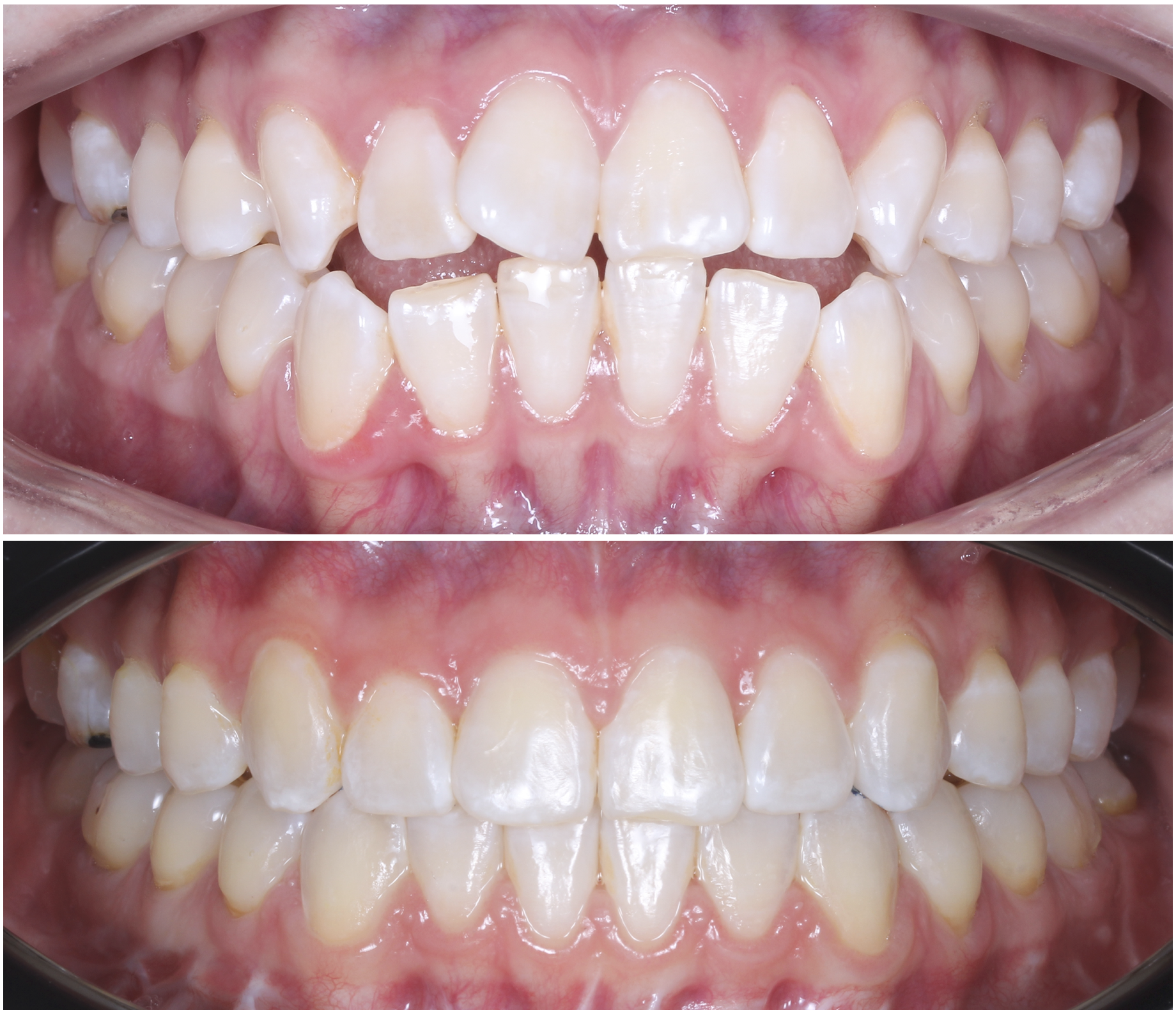Close-up view of human teeth with overlapping and misaligned front teeth, showing gaps and uneven spacing.