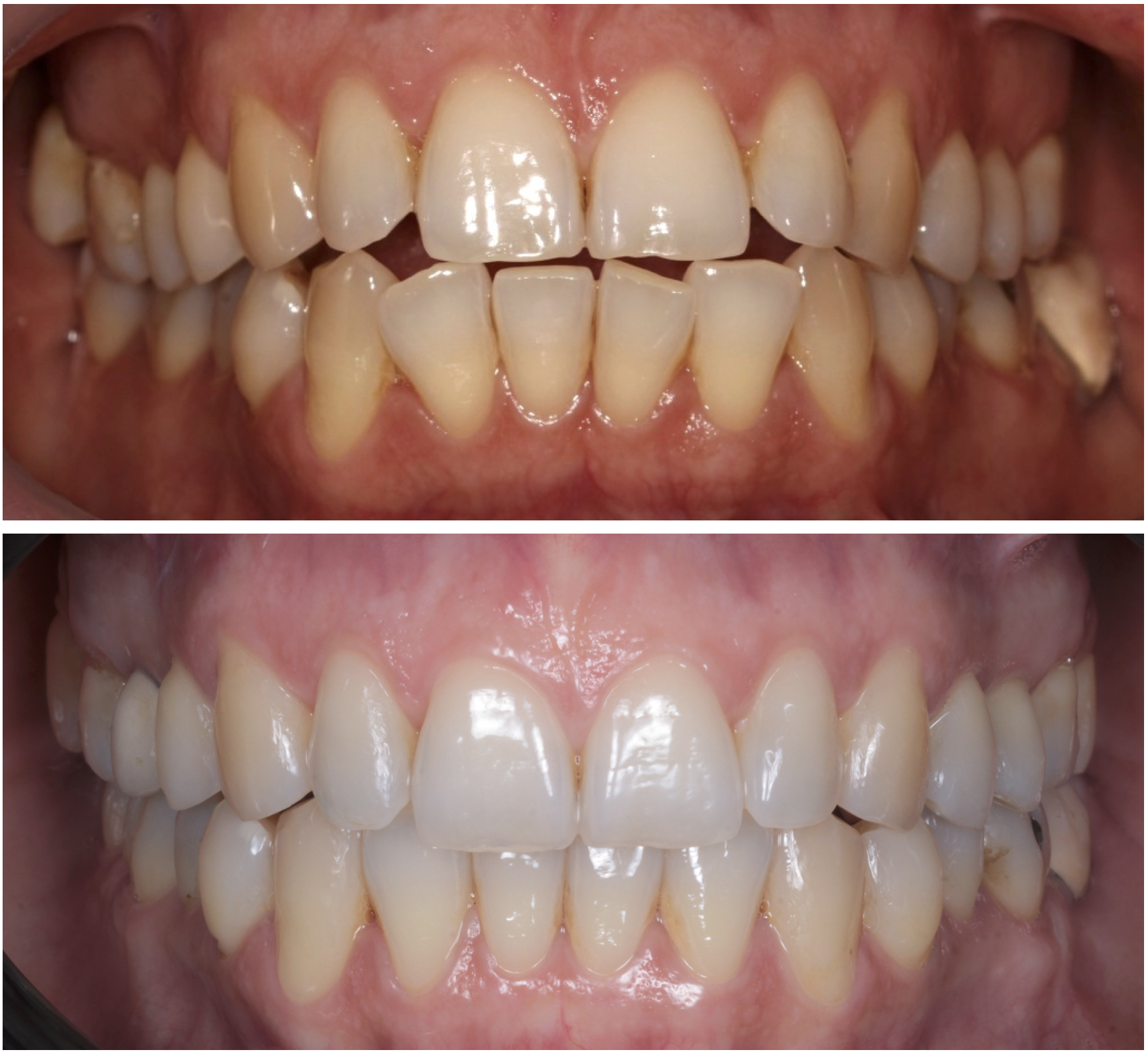 Close-up of a person's teeth showing before and after dental treatment. The top image displays stained, crooked teeth, while the bottom image shows clean, straight, and white teeth.