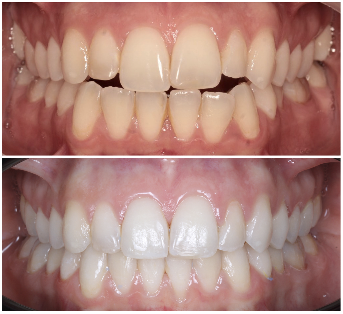 Comparison of human teeth before and after dental treatment, showing improved alignment and whiteness in the bottom image.