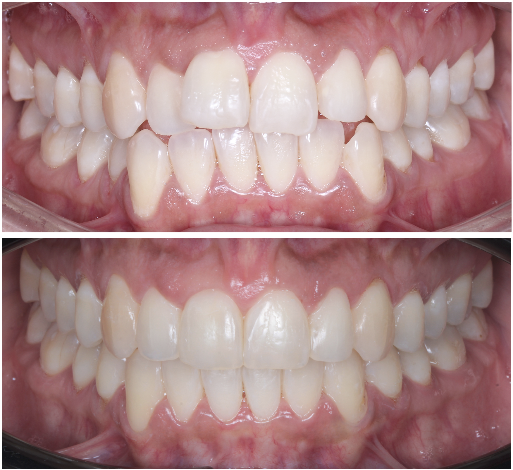 Close-up of a person's upper and lower teeth, showing dental alignment and gum health.