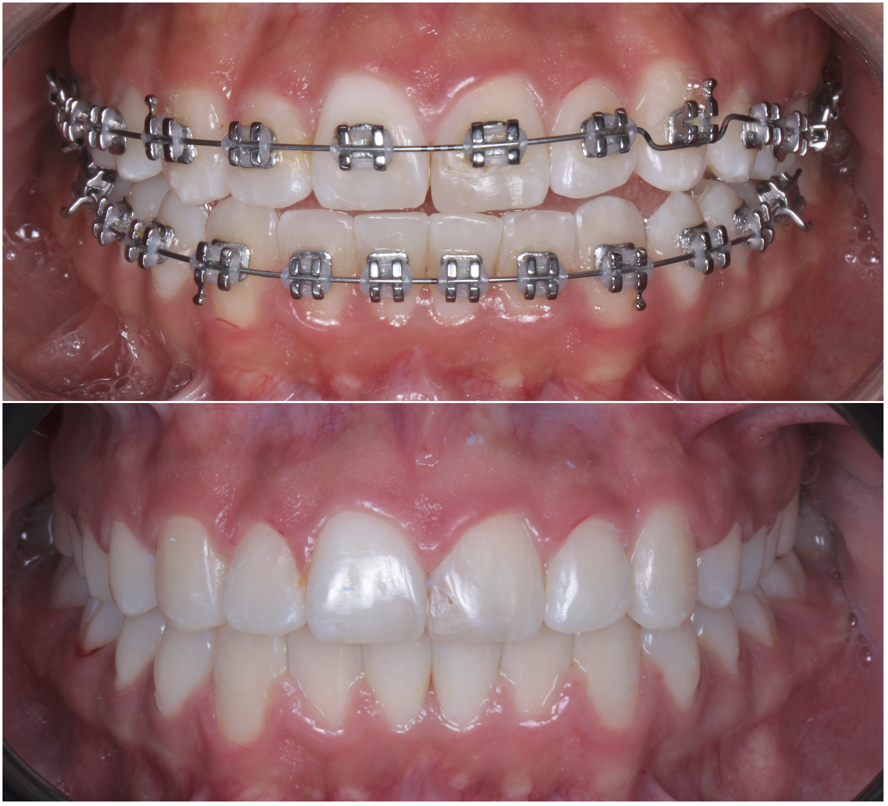 Close-up of a person's mouth showing teeth with braces on both the upper and lower teeth.