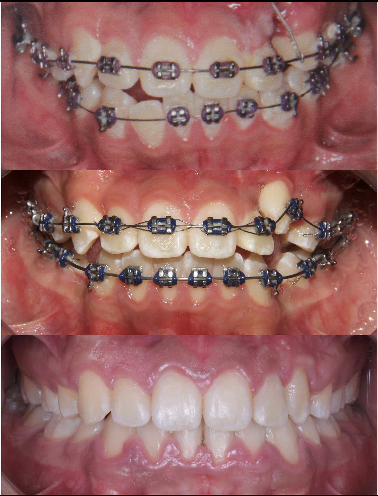 Progression of a person's teeth before, during, and after orthodontic treatment with braces.