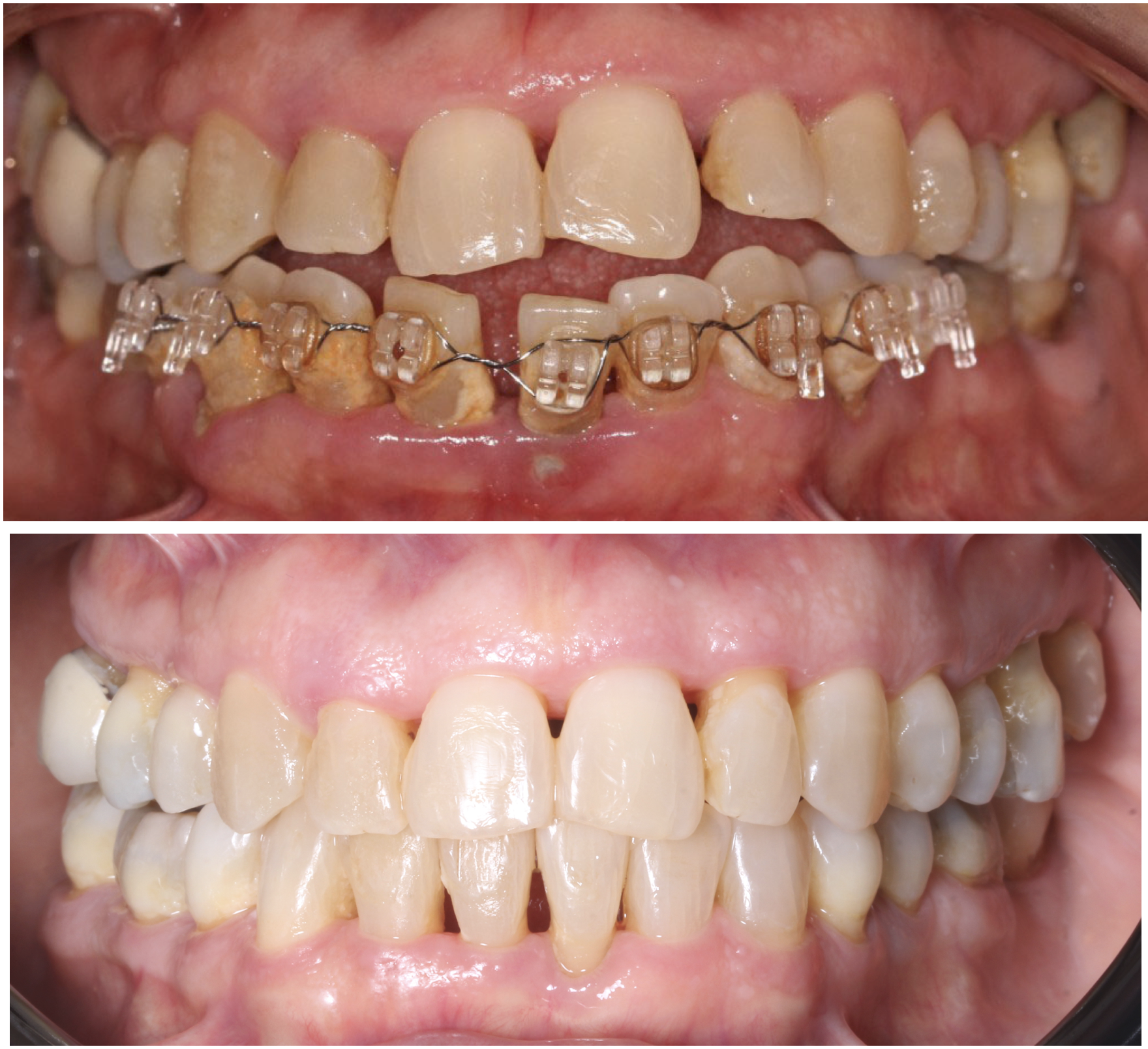 Close-up of a person's mouth showing teeth before and after orthodontic treatment. The top image displays misaligned, stained teeth with braces. The bottom image shows straightened, cleaner teeth after treatment.