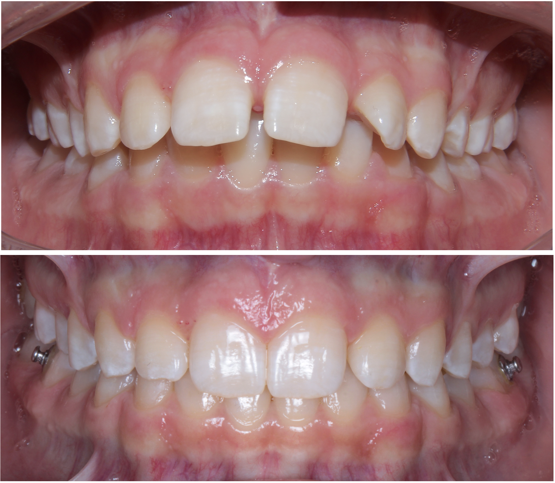 Close-up of a person's upper front teeth showing some misalignment, crowding, and a missing tooth. The gums appear red and slightly inflamed.
