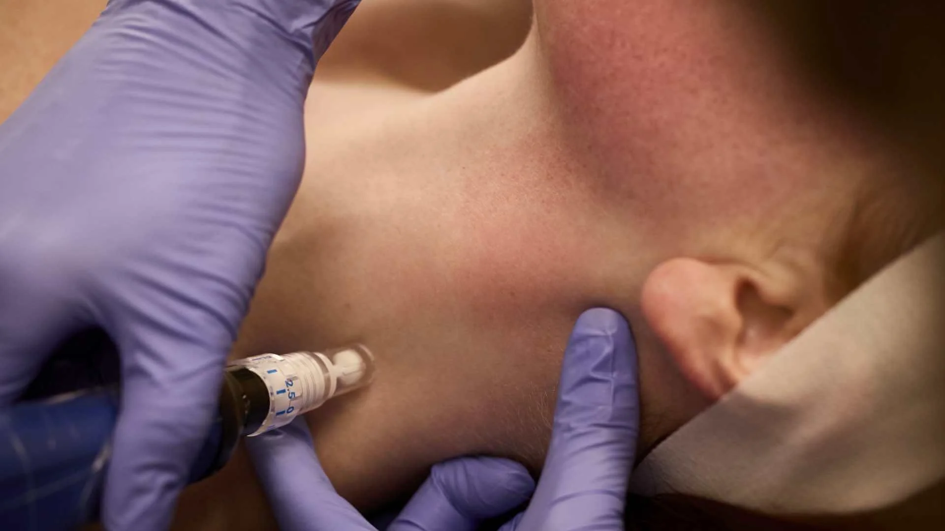 SkinPen® Precision Microneedling